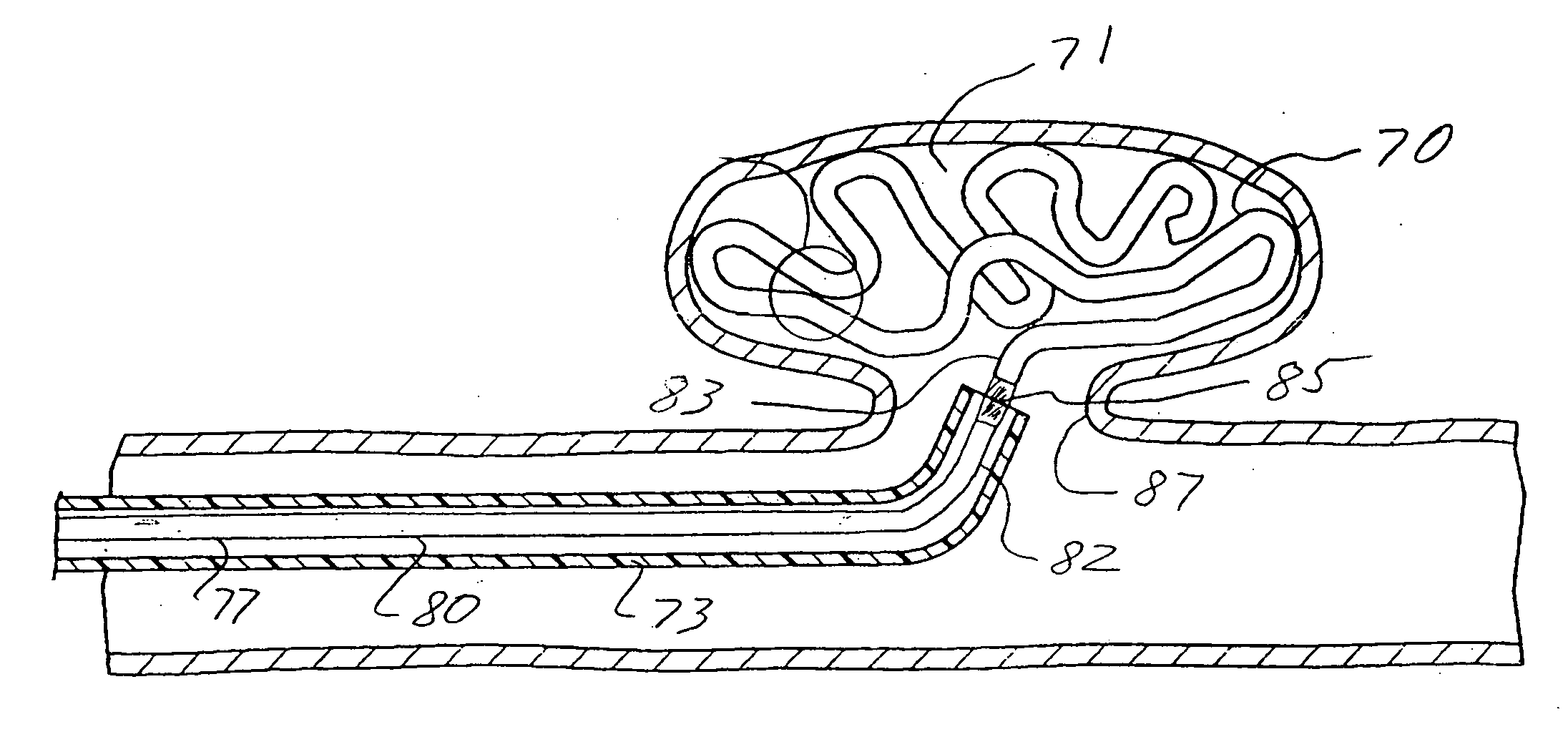 Intracorporeal occlusive device and method