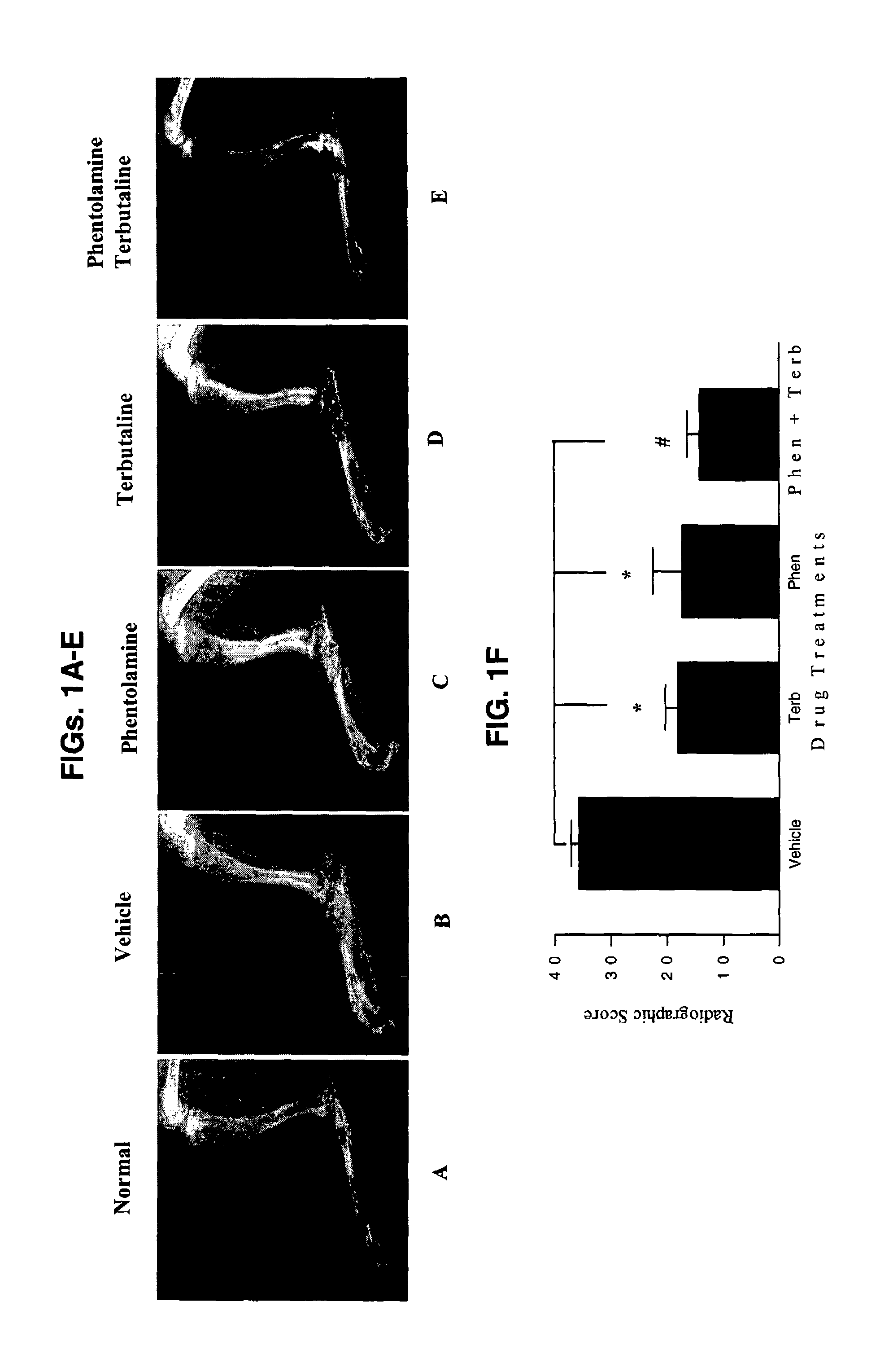 Treatment of inflammatory autoimmune diseases with alpha-adrenergic antagonists and beta-adrenergic agonists