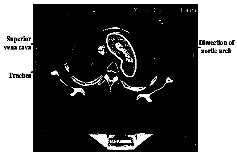 Aortic dissection dynamic detection method based on morphology and deep learning