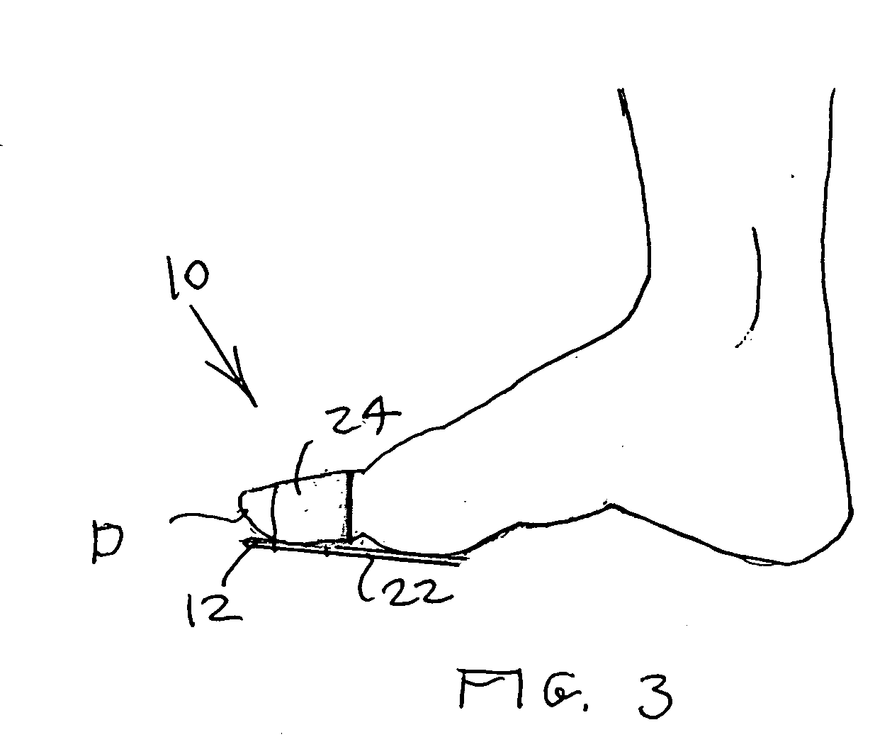 Compact universal splint apparatus for focused immobilization such as of a single digit of the foot or hand, and method