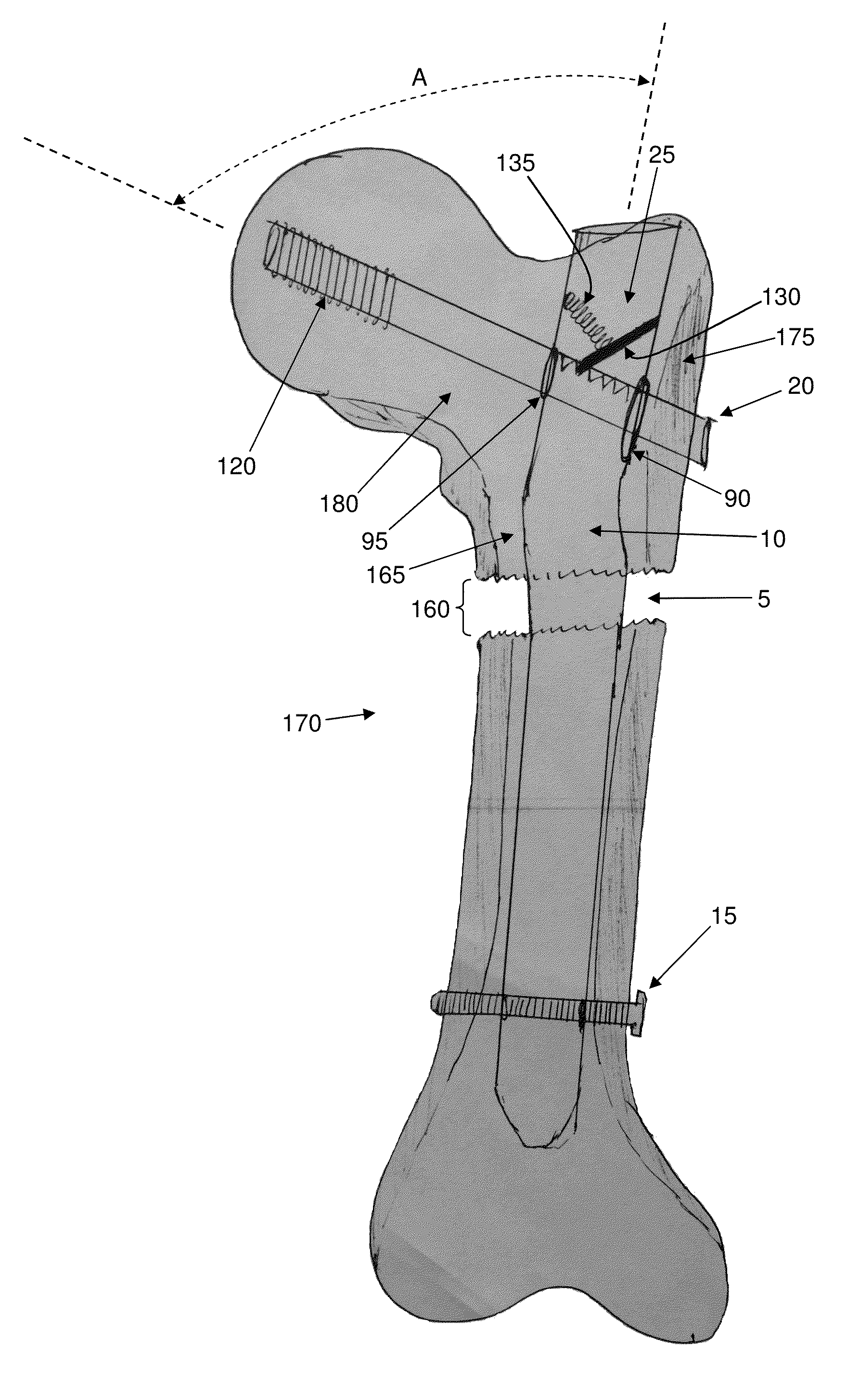 Interlocking intramedullary rod assembly for proximal femoral fractures, including unstable hip fractures