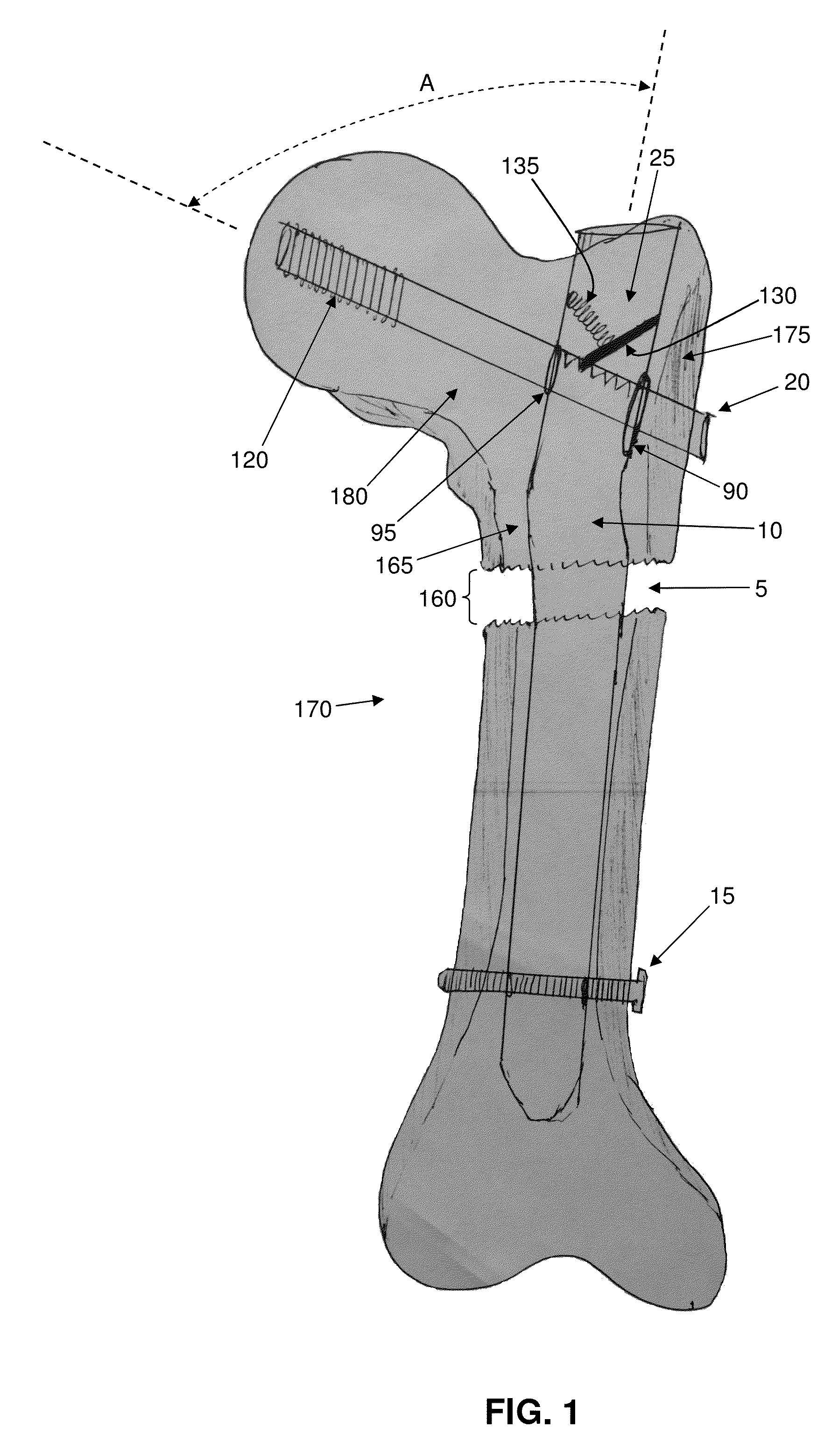 Interlocking intramedullary rod assembly for proximal femoral fractures, including unstable hip fractures