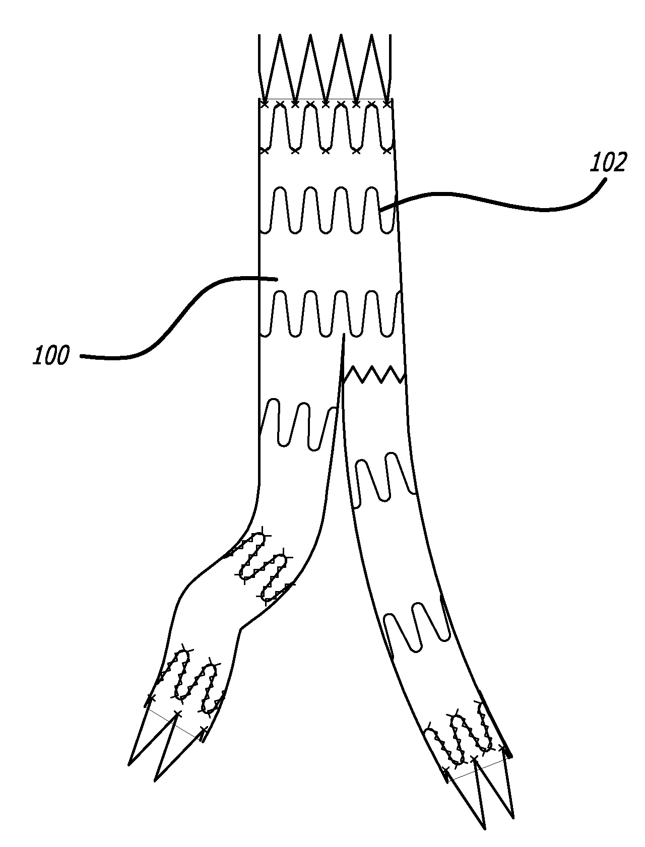 Galvanic Corrosion Methods and Devices for Fixation of Stent Grafts