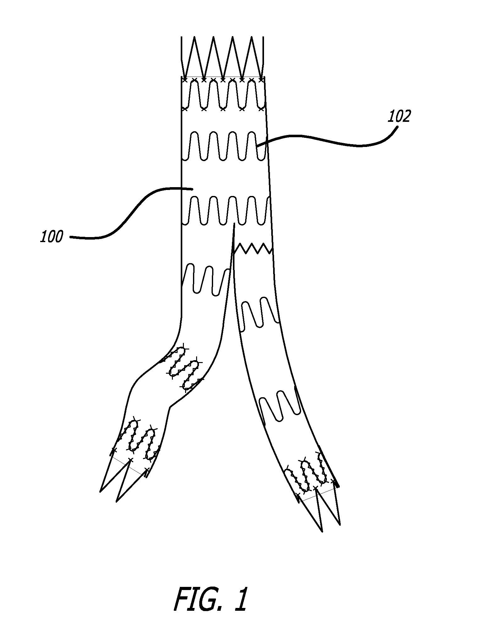 Galvanic Corrosion Methods and Devices for Fixation of Stent Grafts