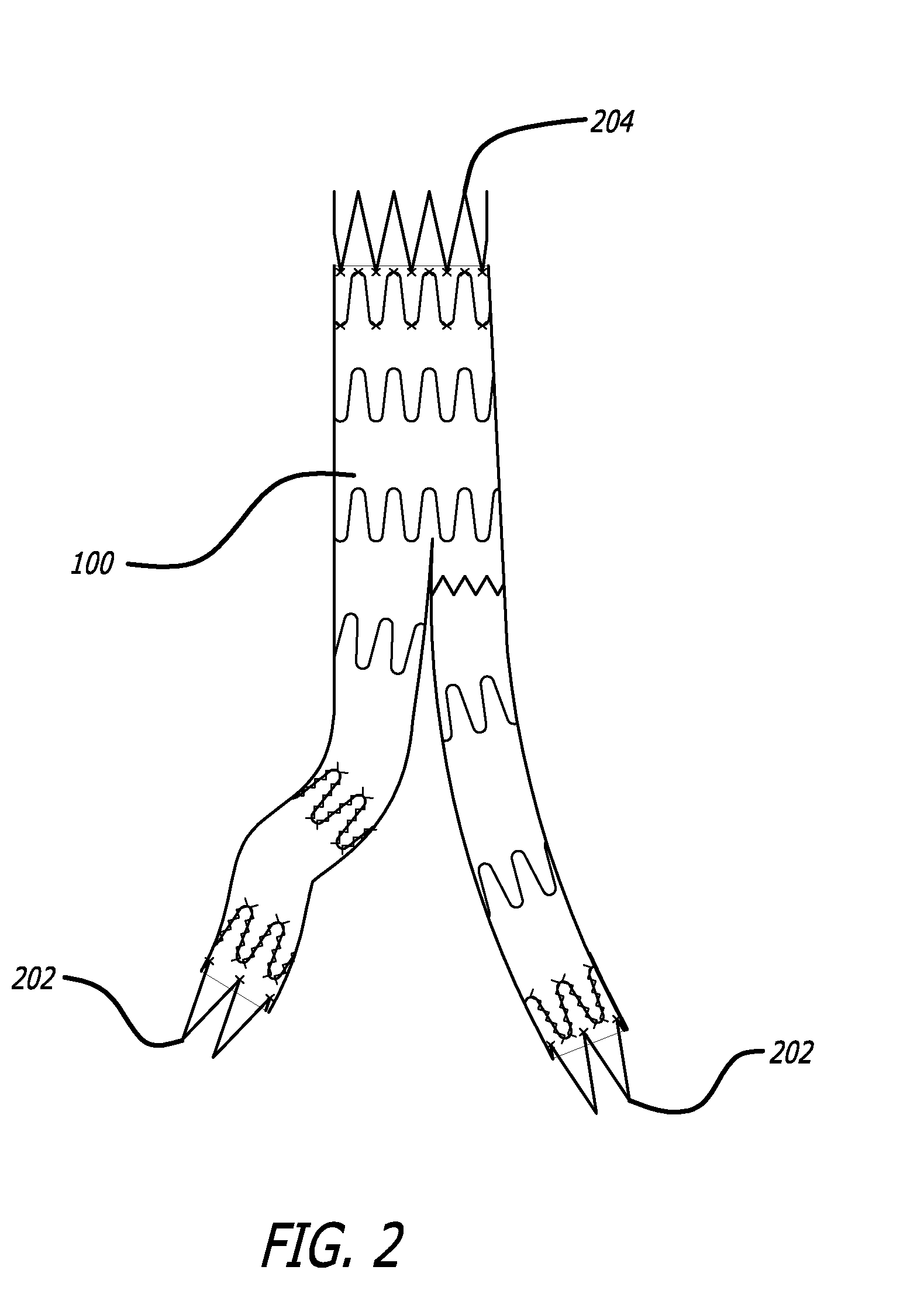 Galvanic Corrosion Methods and Devices for Fixation of Stent Grafts