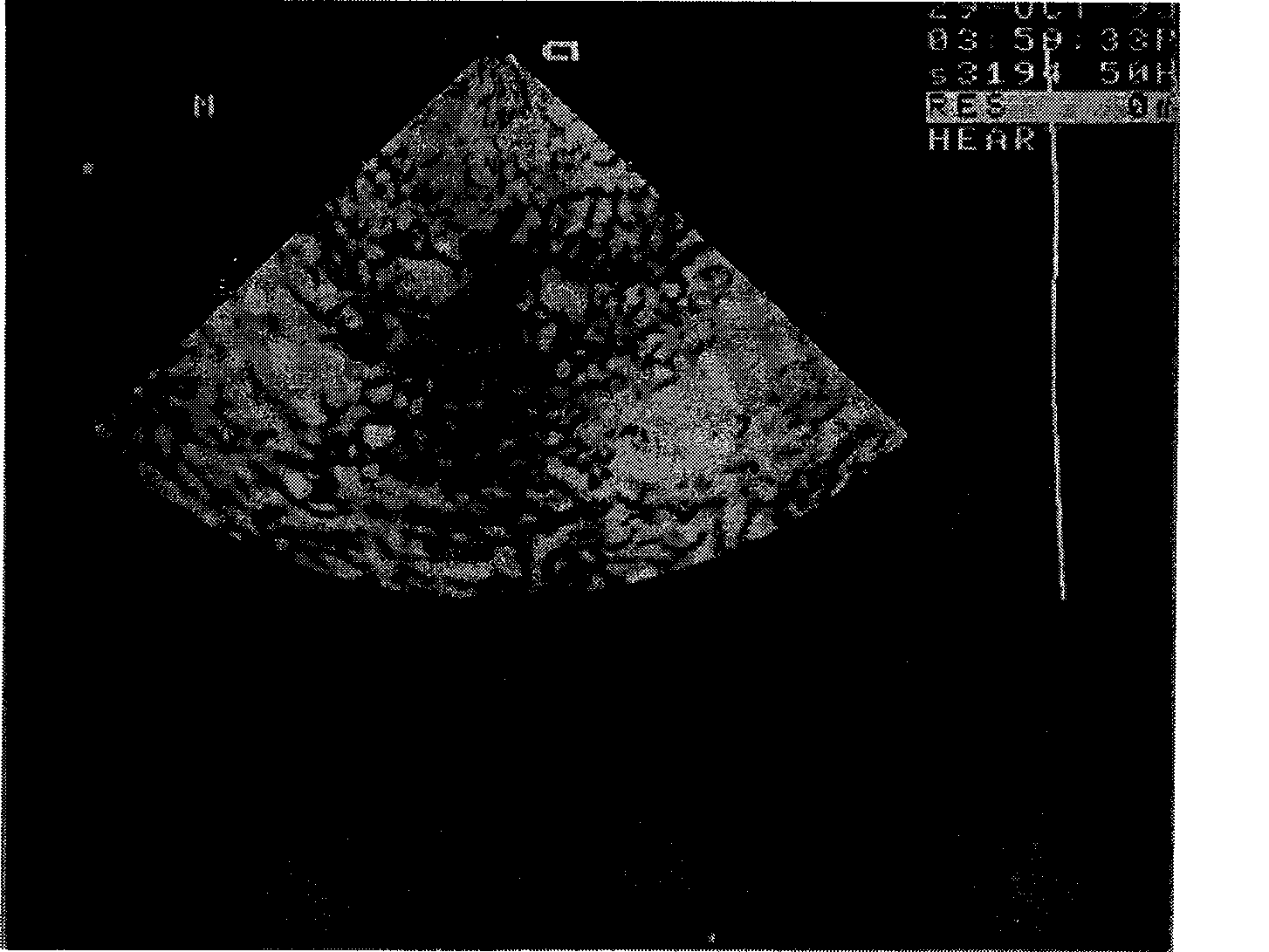 Method for preparing silkworm powder, pupa powder or pupa serum powder containing antibacterial peptide and application of same