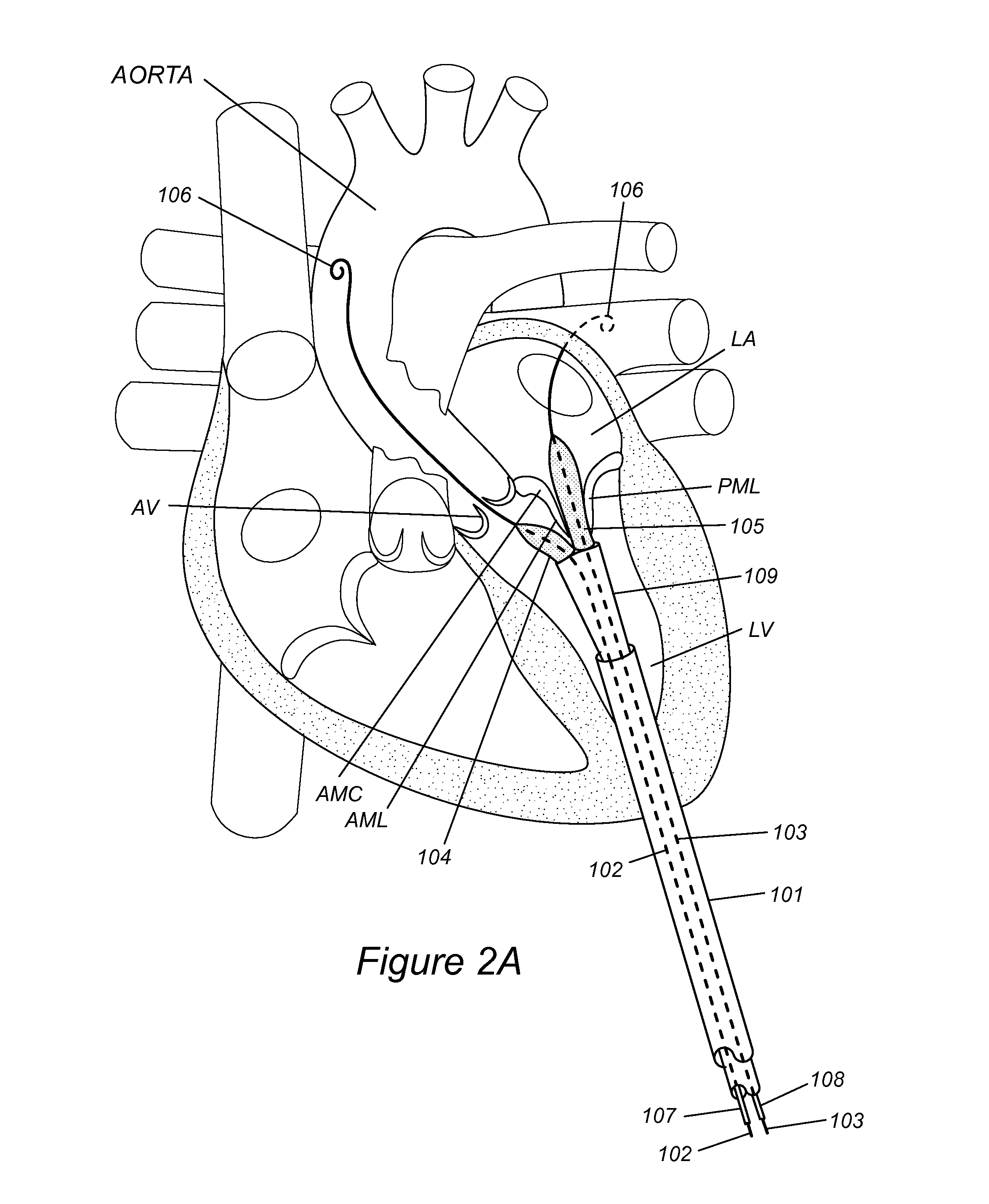 Anatomically-orientated and self-positioning transcatheter mitral valve