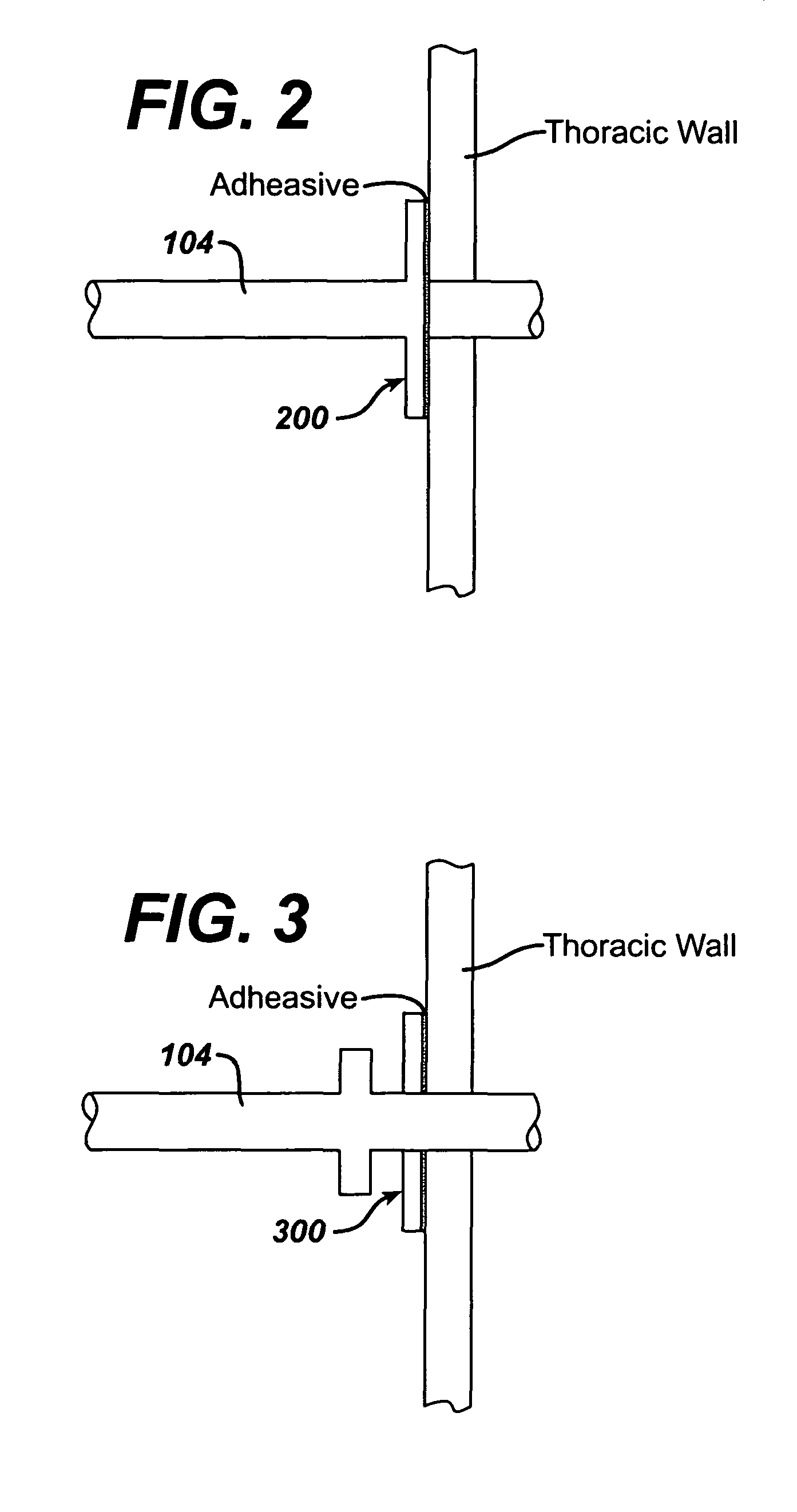 Method for treating chronic obstructive pulmonary disease