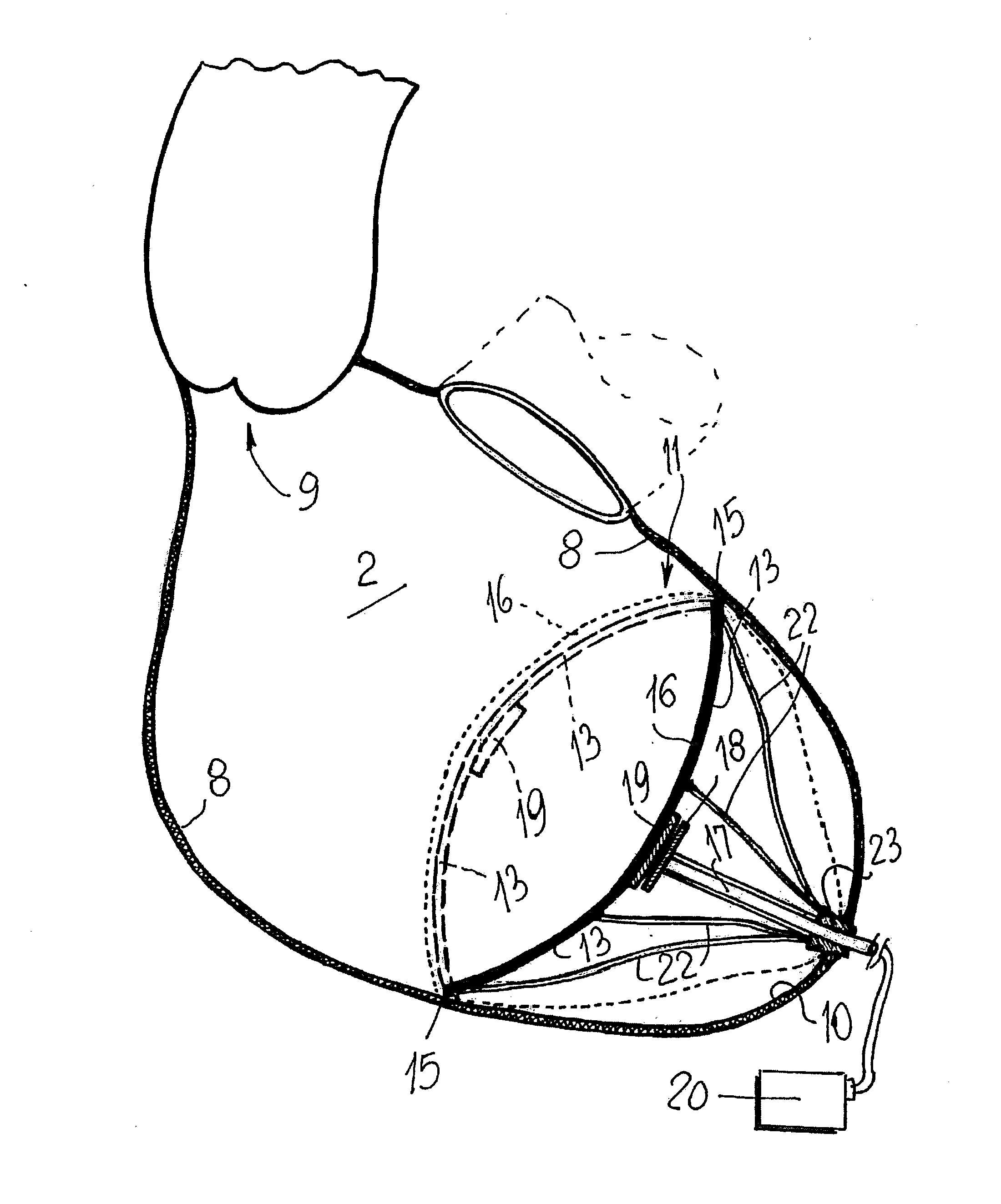 Cardiovascular device