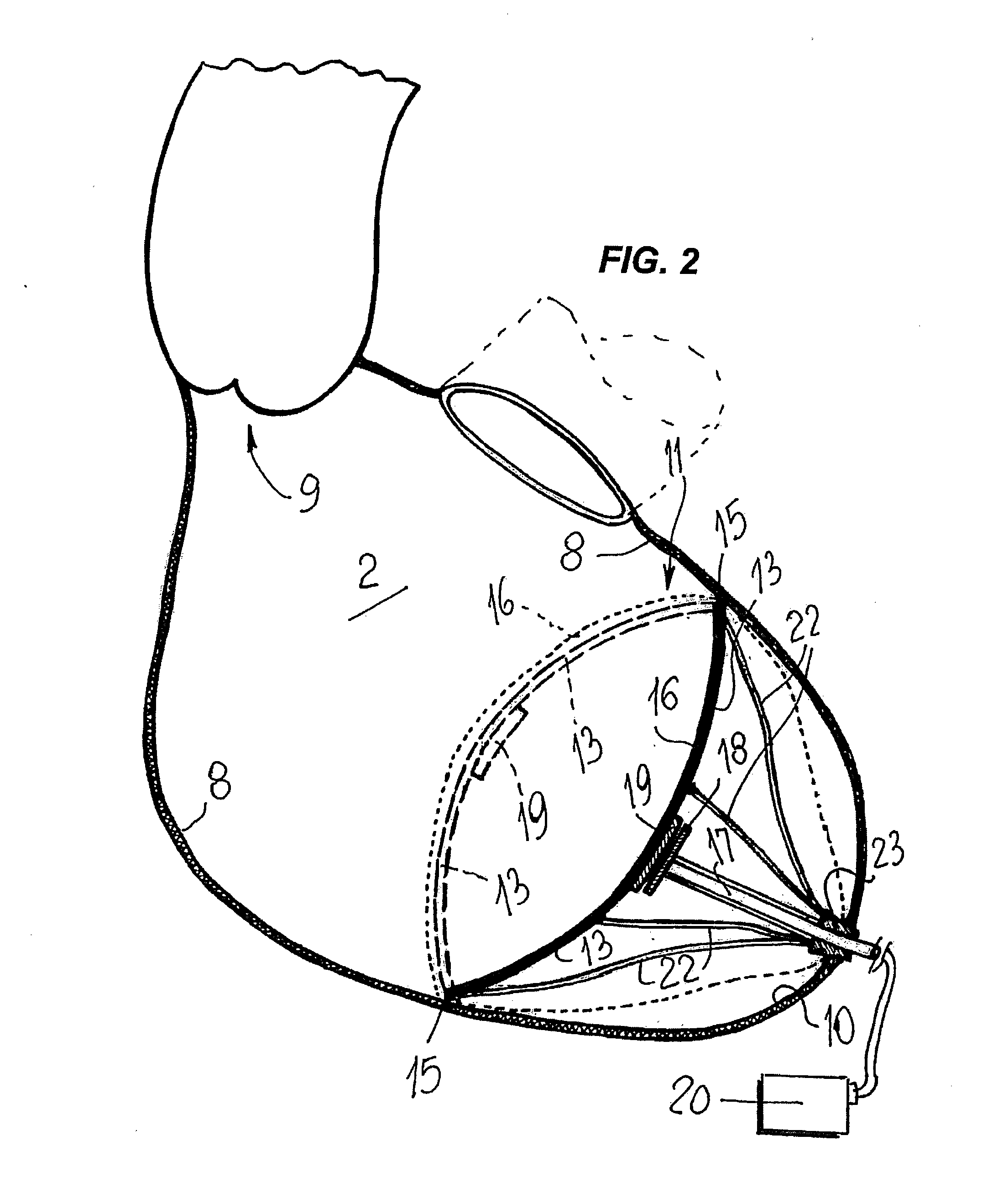 Cardiovascular device