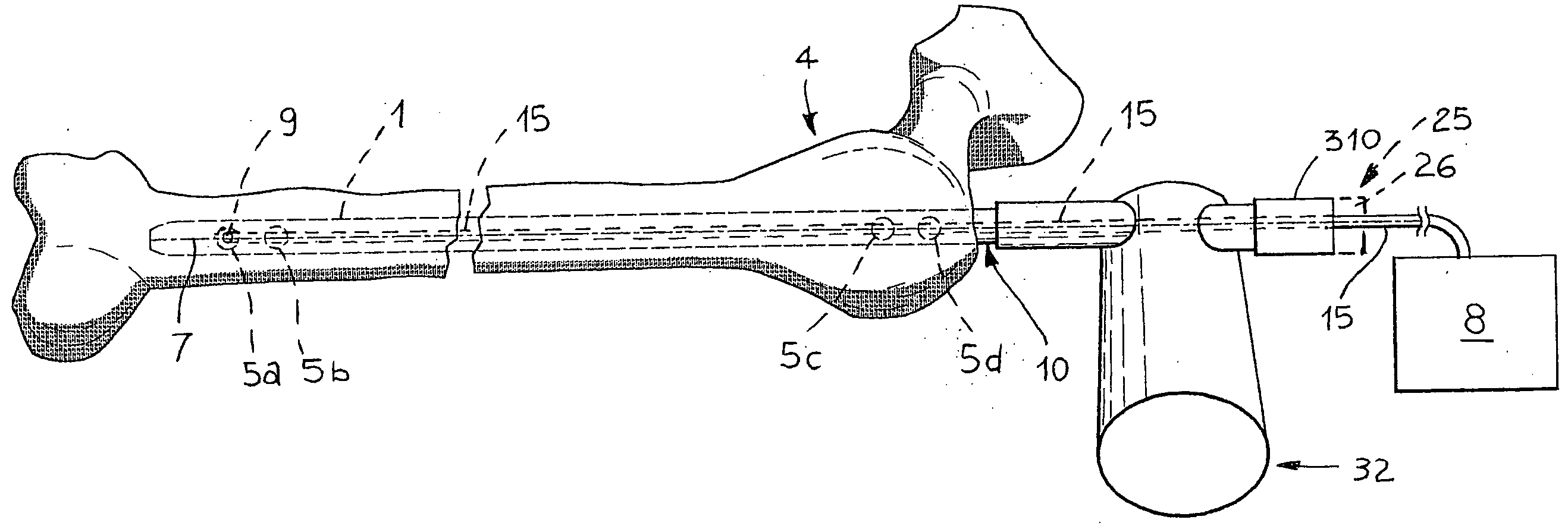 Apparatus for the osteosynthesis of bone fractures by means of locked endomedullary nailing