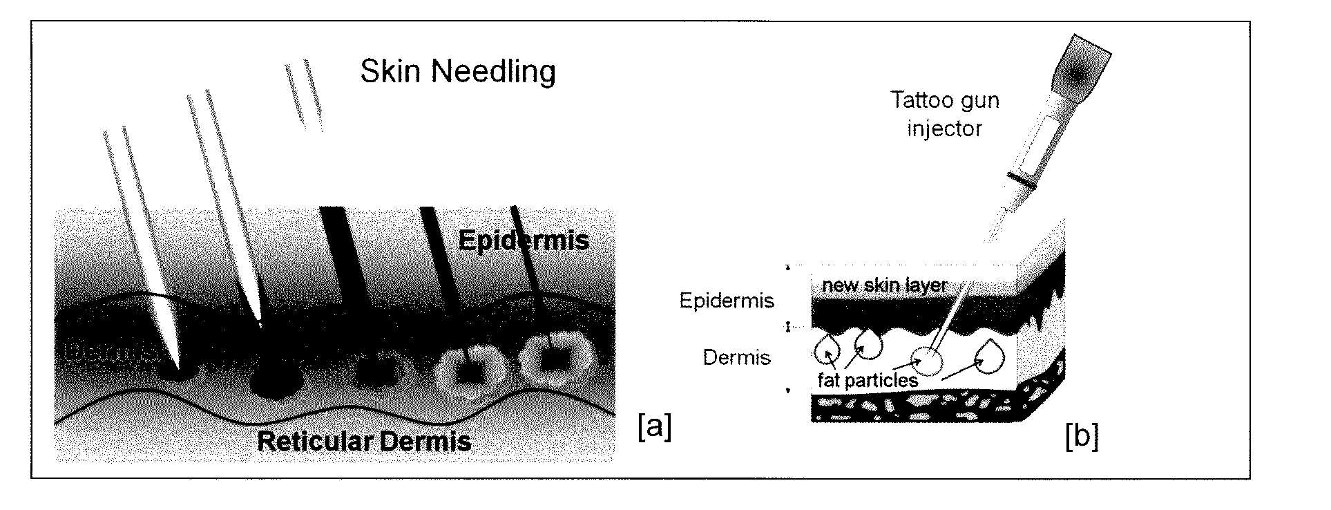 Surgical methods/devices for tissue injury removal by tattooing of autologous stem cells