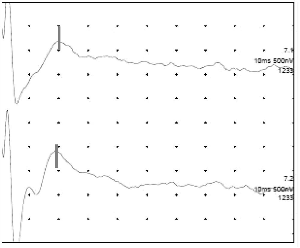 An electrophysiological testing device for automated auditory brainstem implants