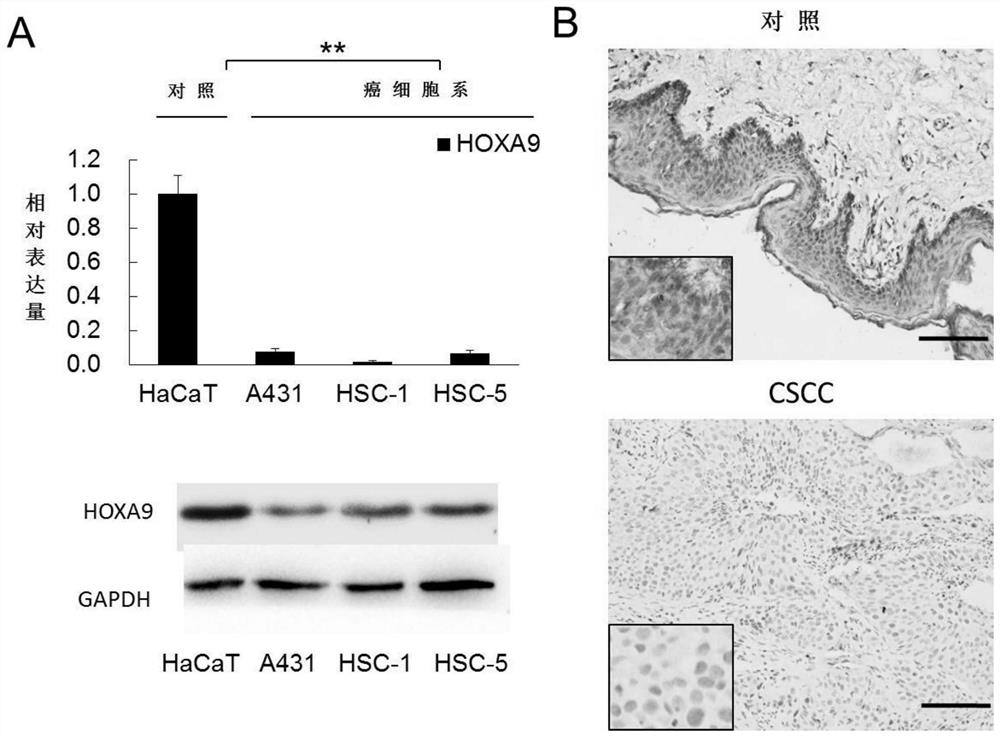 Application of hoxa9 gene in preparation of medicine for treating skin squamous cell carcinoma