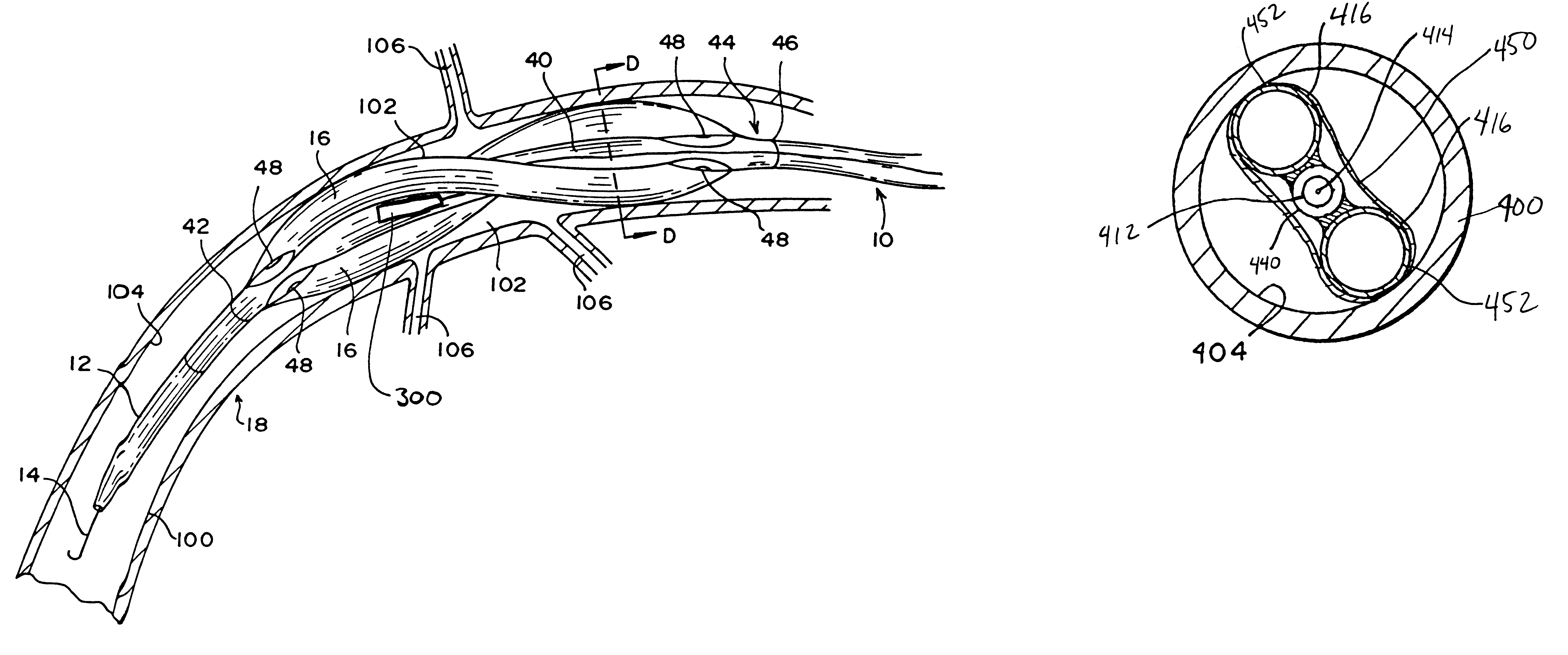 Helical spiral balloon catheter