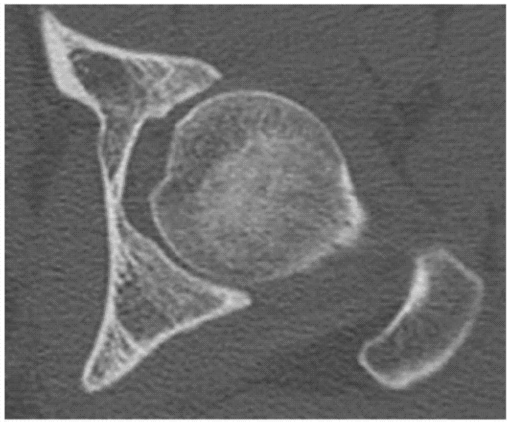 Acetabular tissue model reconstruction method for serialized hip joint CT images