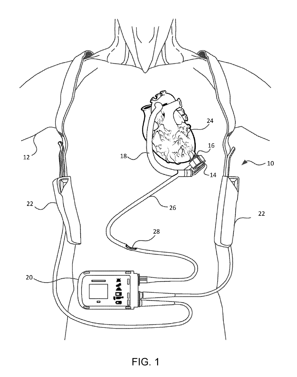 Improved Blood Pump Connectors