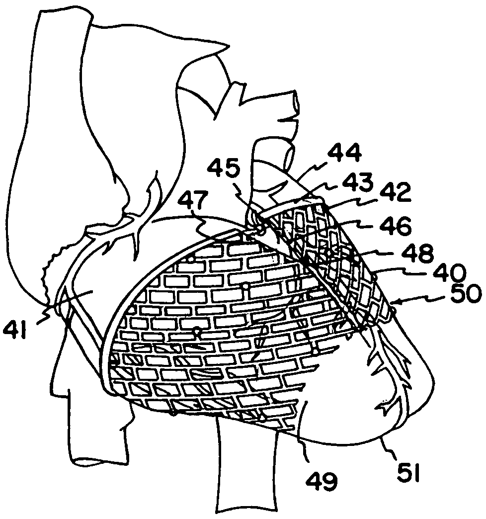 Cardiac reinforcement device