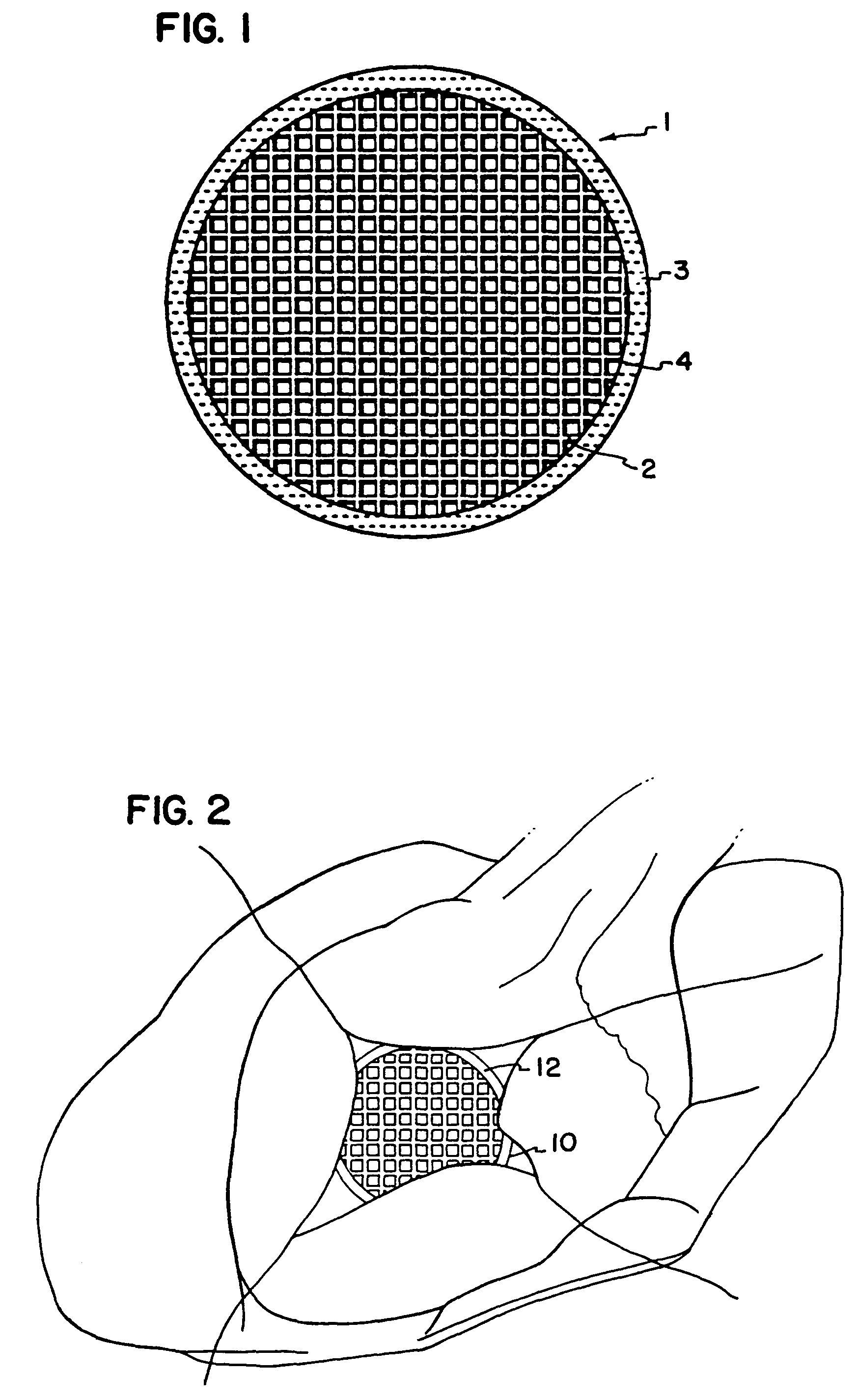 Cardiac reinforcement device