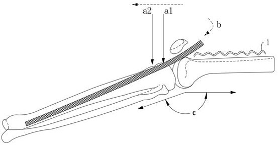 Pressure sore prevention pad for semi-extended straight infrapatellar approach tibia intramedullary nail surgery