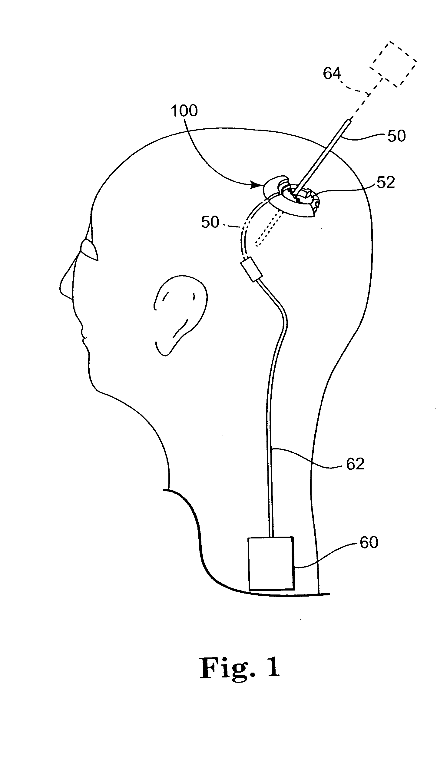 Methods and apparatus for securing a therapy delivery device within a burr hole