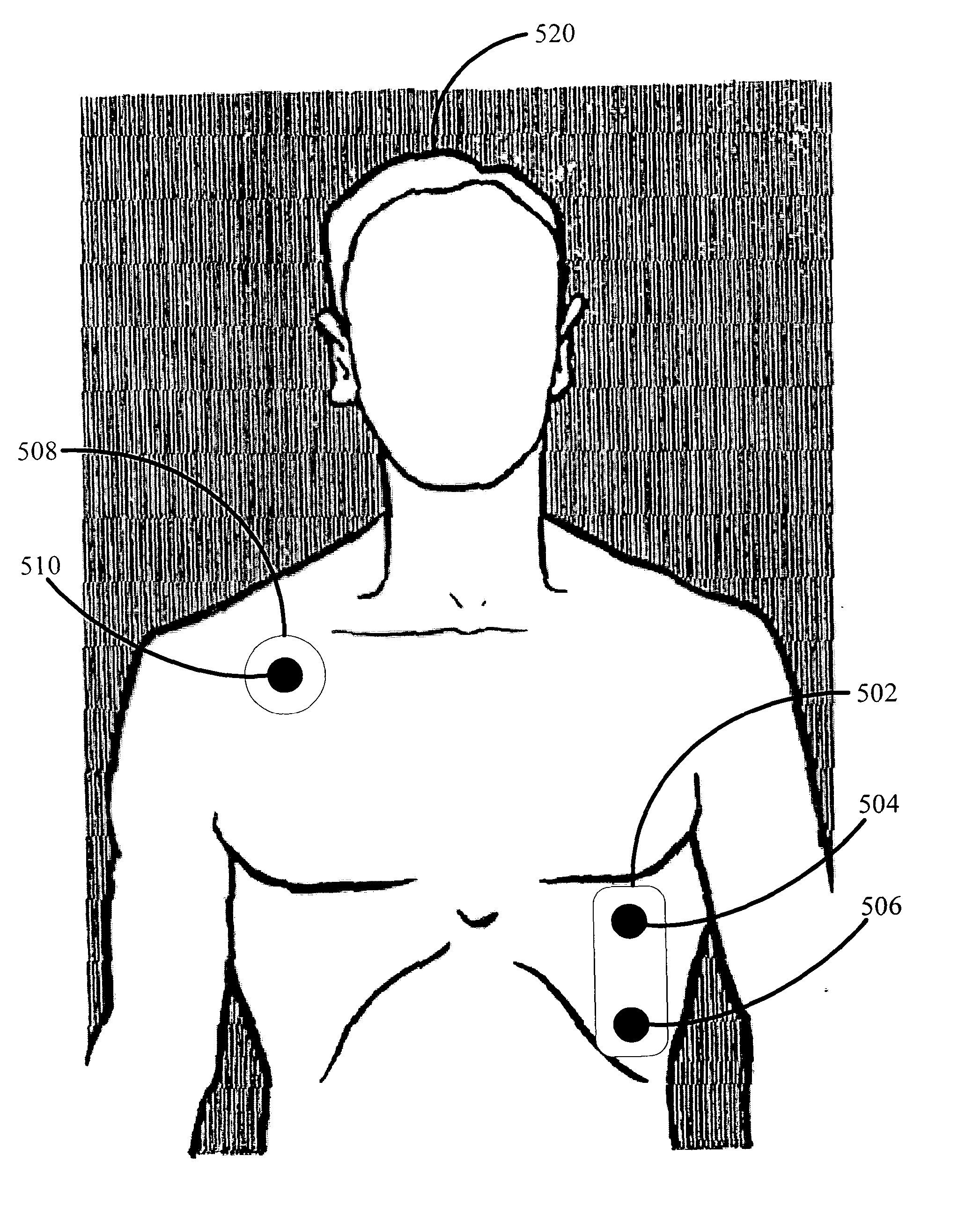 Remote electrocardiogram for early detection of coronary heart disease