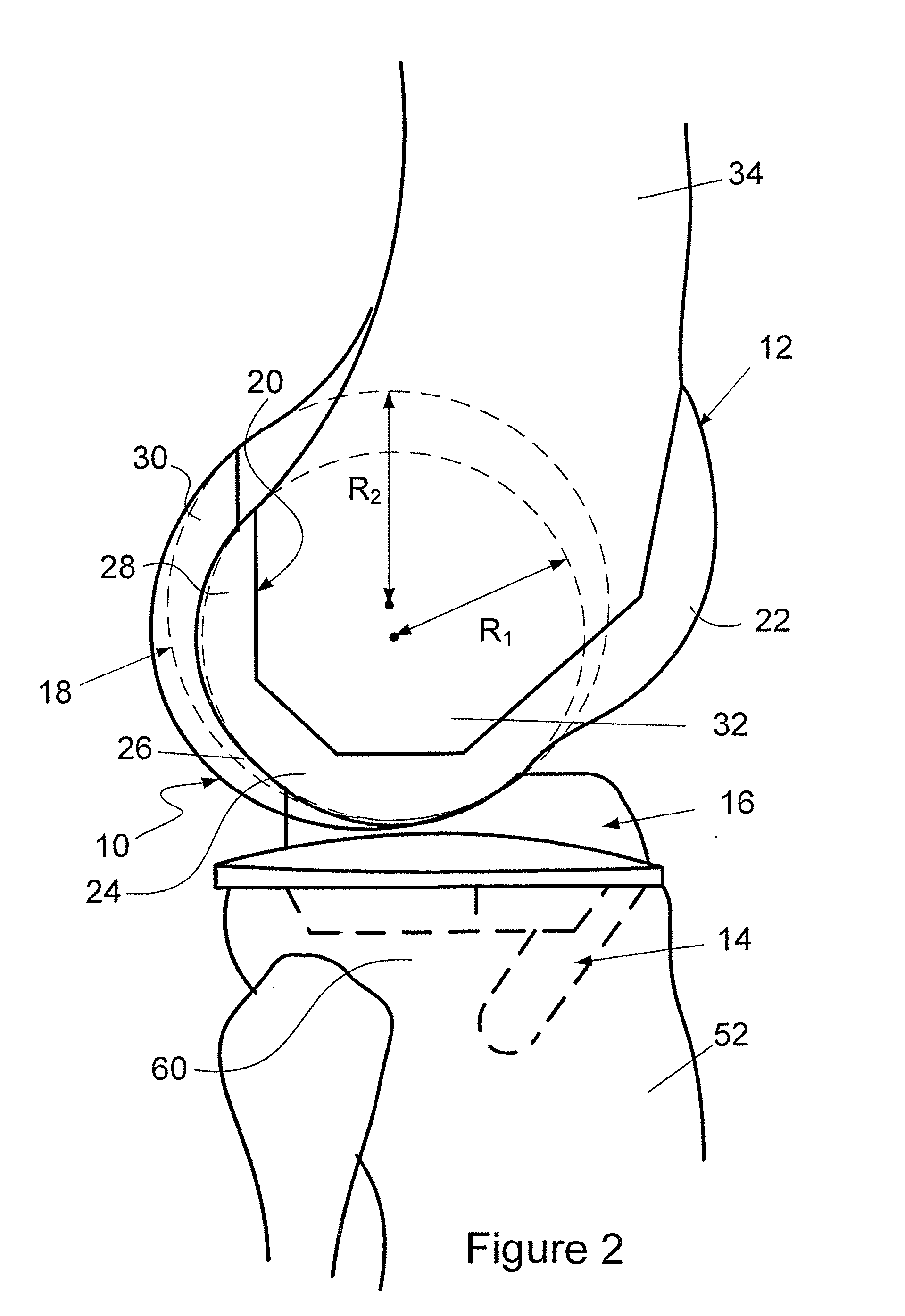 Prosthetic Knee