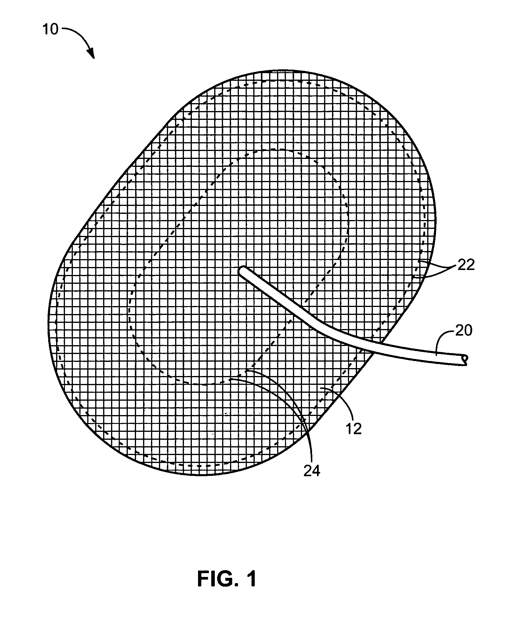 Inflatable hernia patch