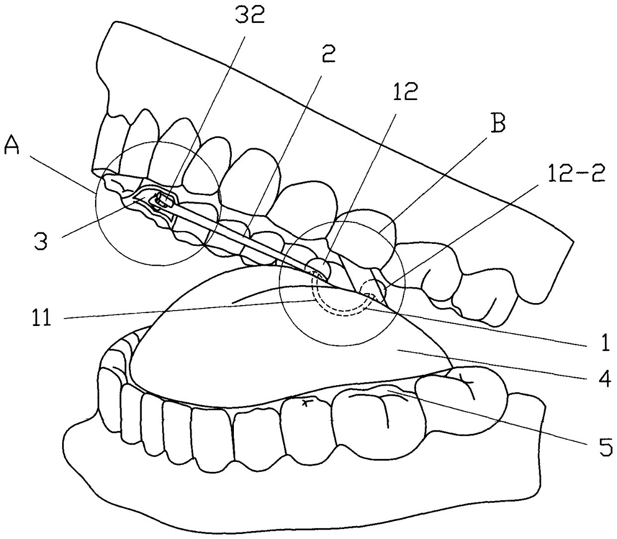 Tongue back elastic traction device and implantation method