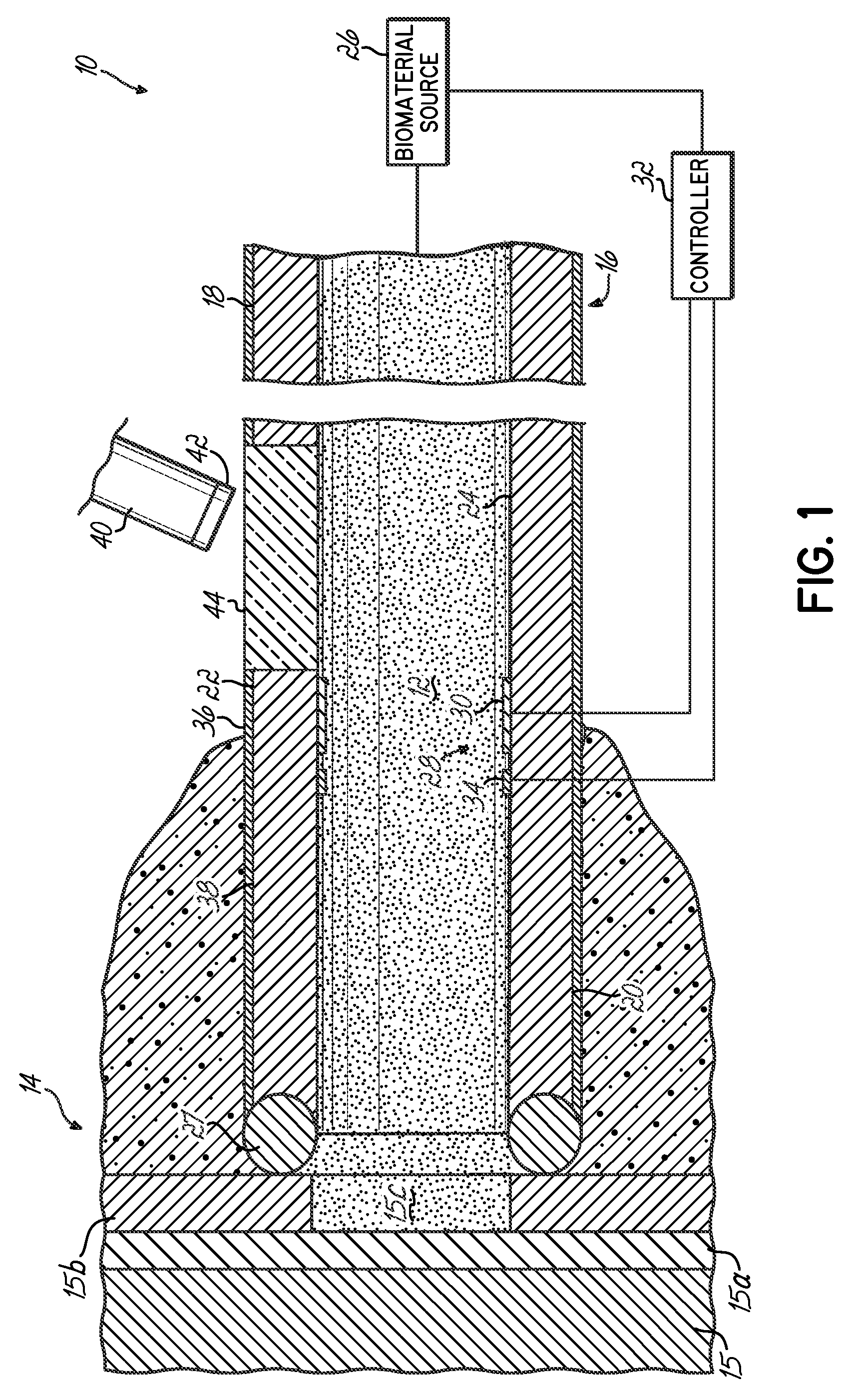 Apparatus and method for delivering a biocompatible material to a surgical site