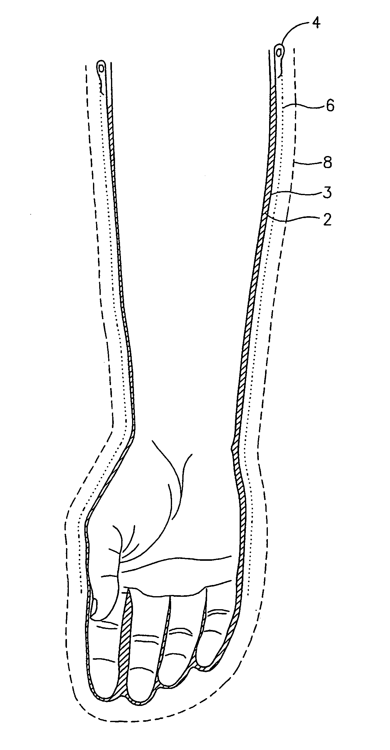 Apparatus and methods for enzymatic escharotomy in burn induced compartment syndrome