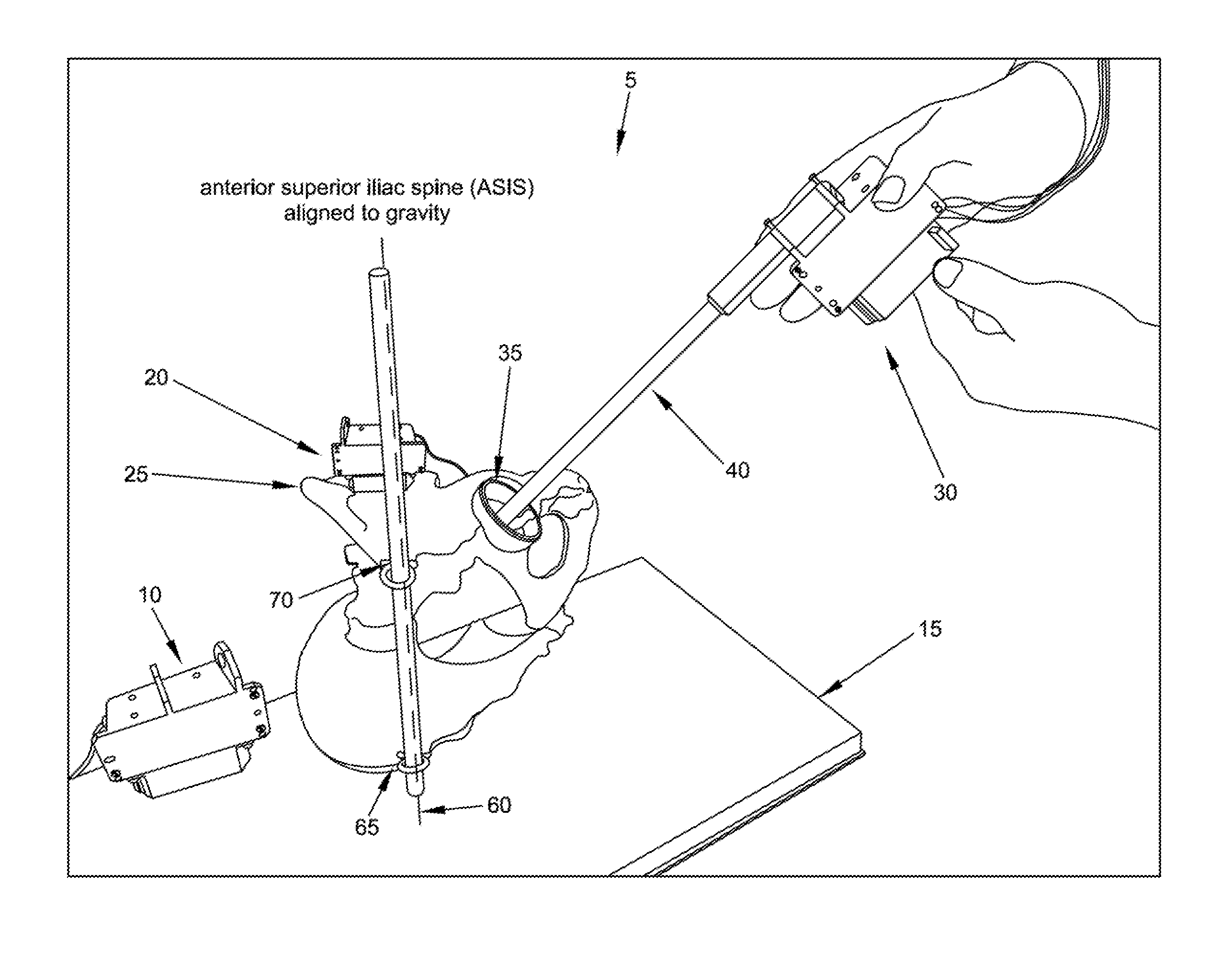 Computer-guided system for orienting a prosthetic acetabular cup in the acetabulum during total hip replacement surgery