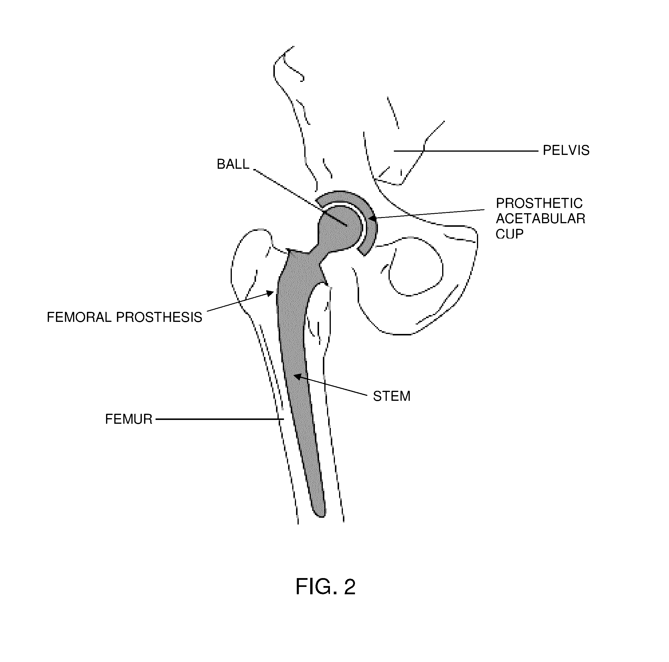 Computer-guided system for orienting a prosthetic acetabular cup in the acetabulum during total hip replacement surgery