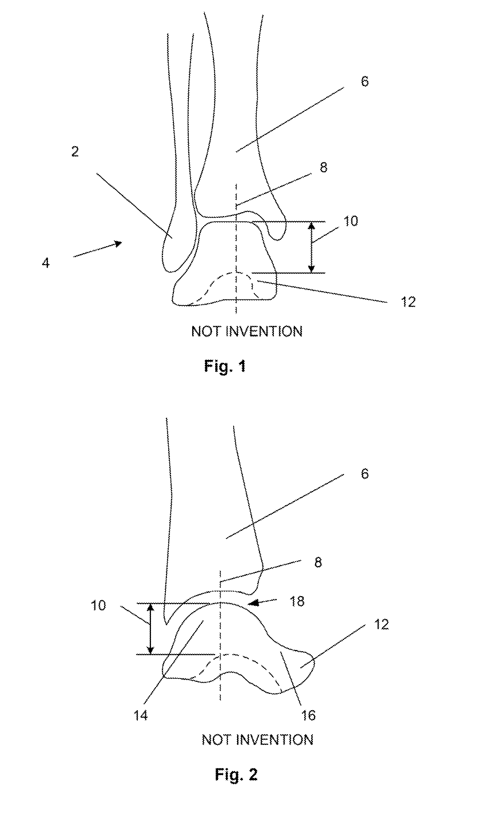 Methods and devices for deploying biological implants