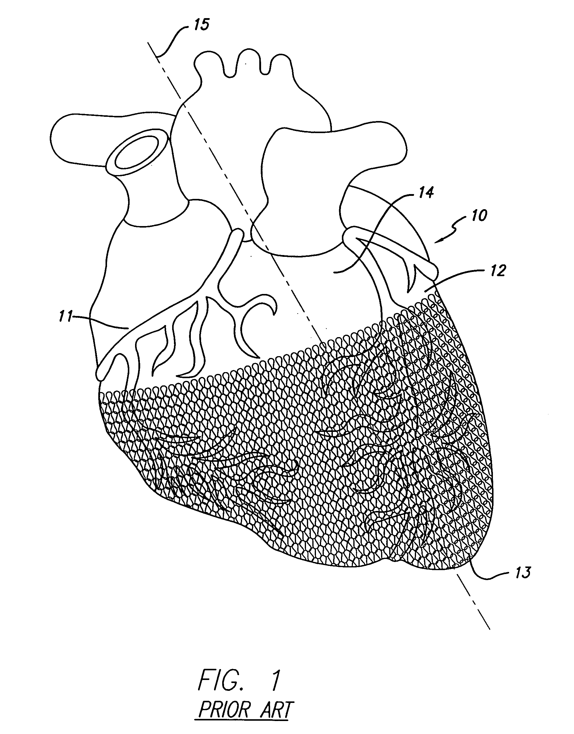 Cardiac harness for treating congestive heart failure and for defibrillating and/or pacing/sensing