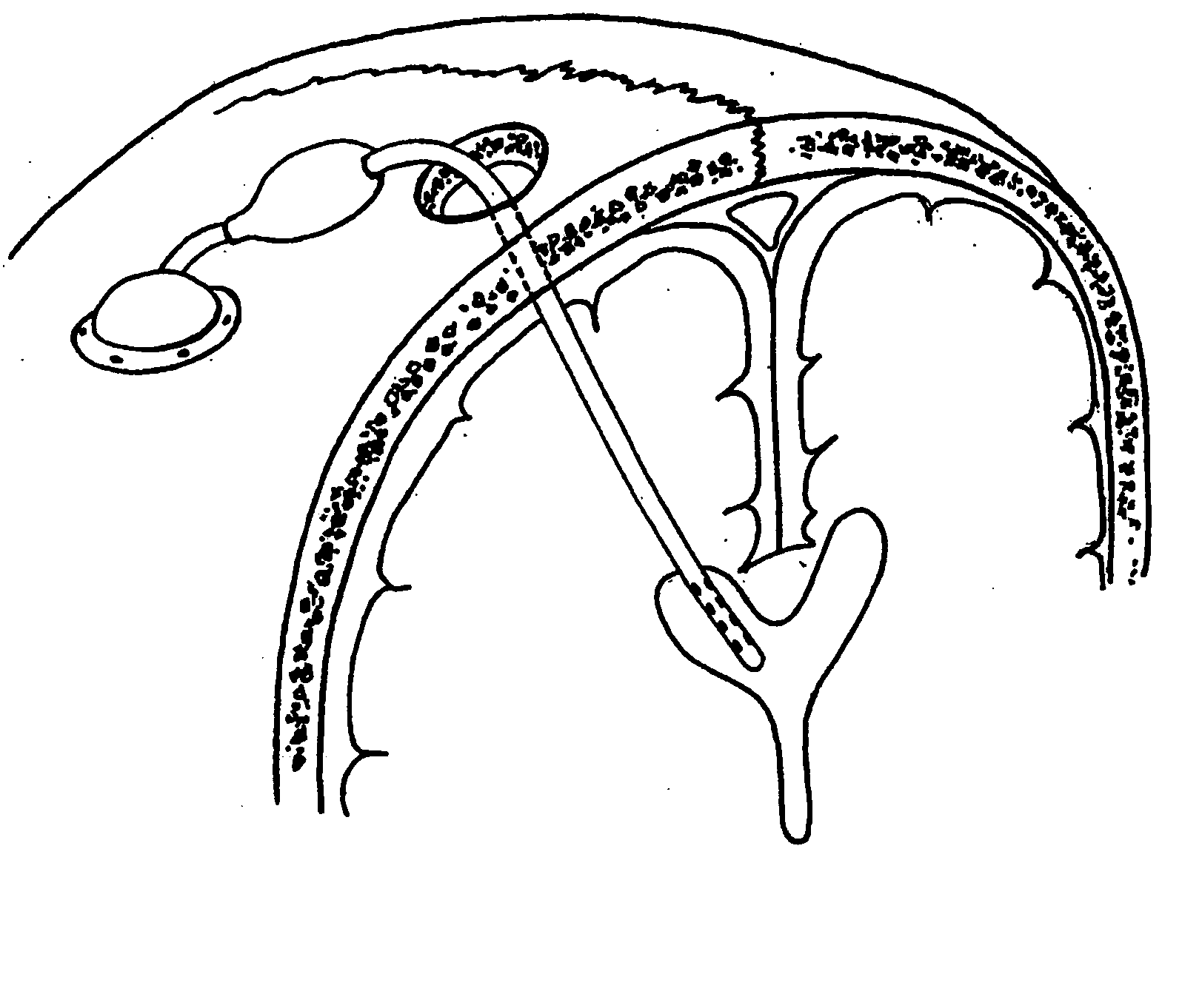 Systems and methods for CSF drainage