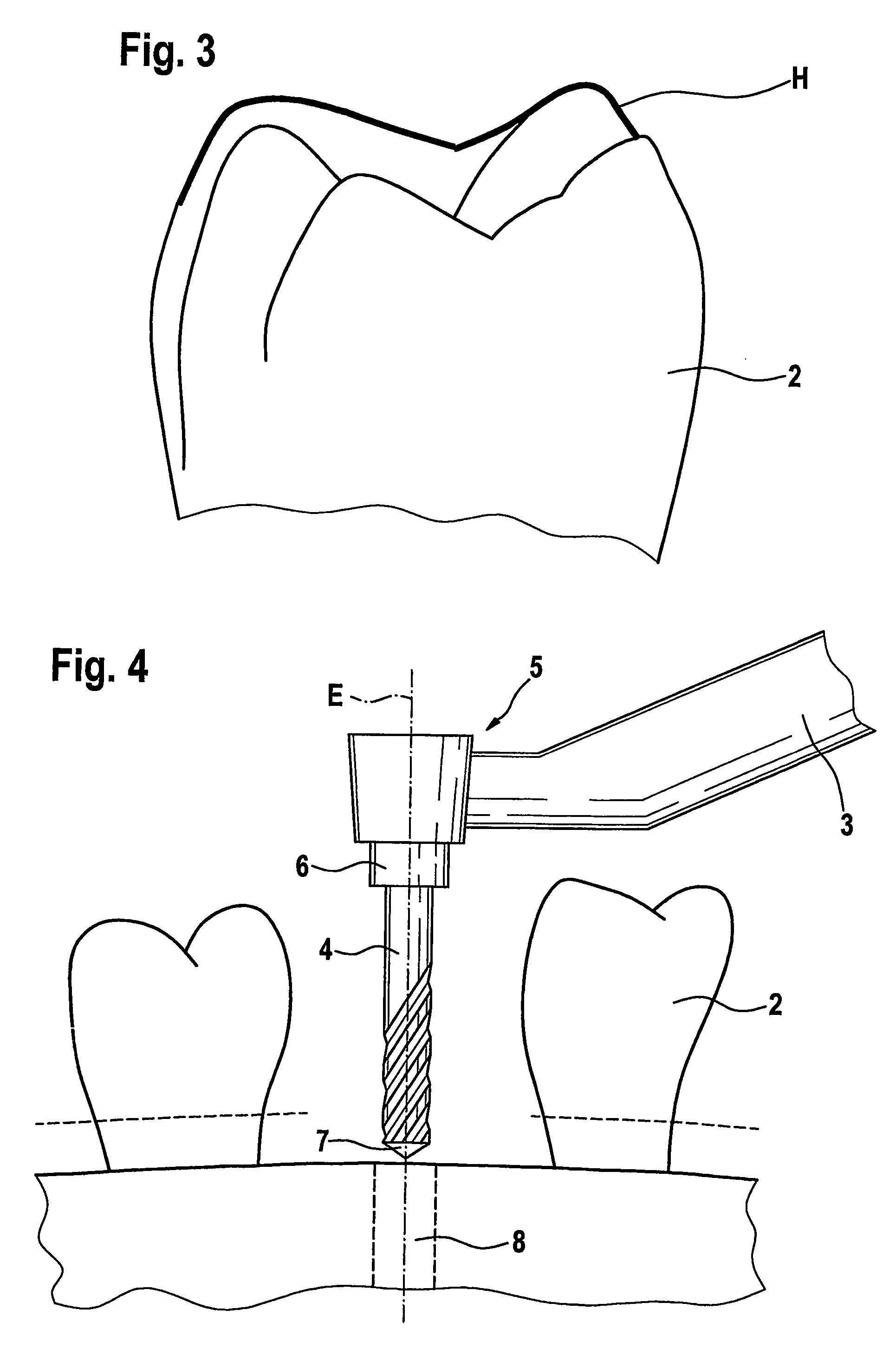 Method for precisely-positioned production of a cavity, especially a bone cavity and instrument therefor