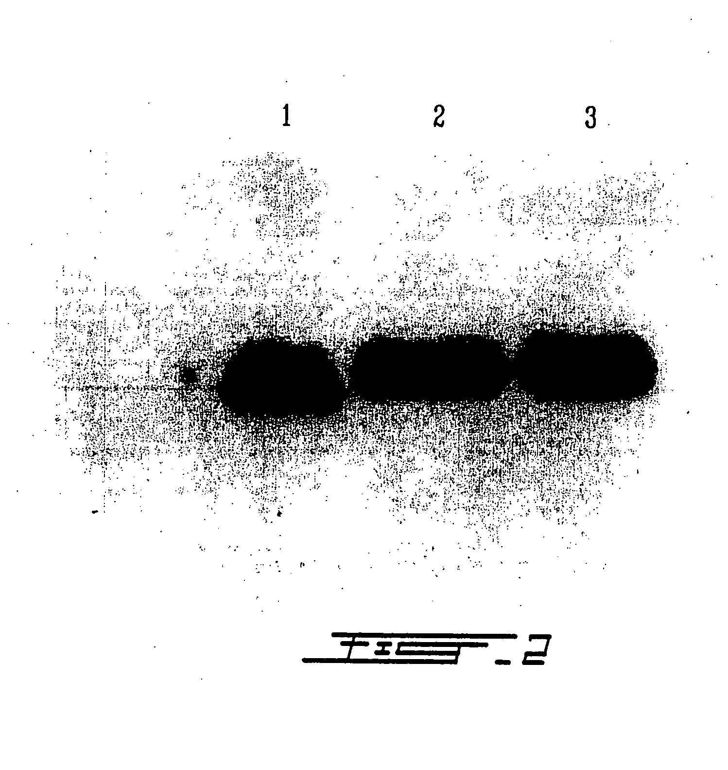 Treatment of macular degeneration with ADP-ribosyl transferase fusion protein therapeutic compositions