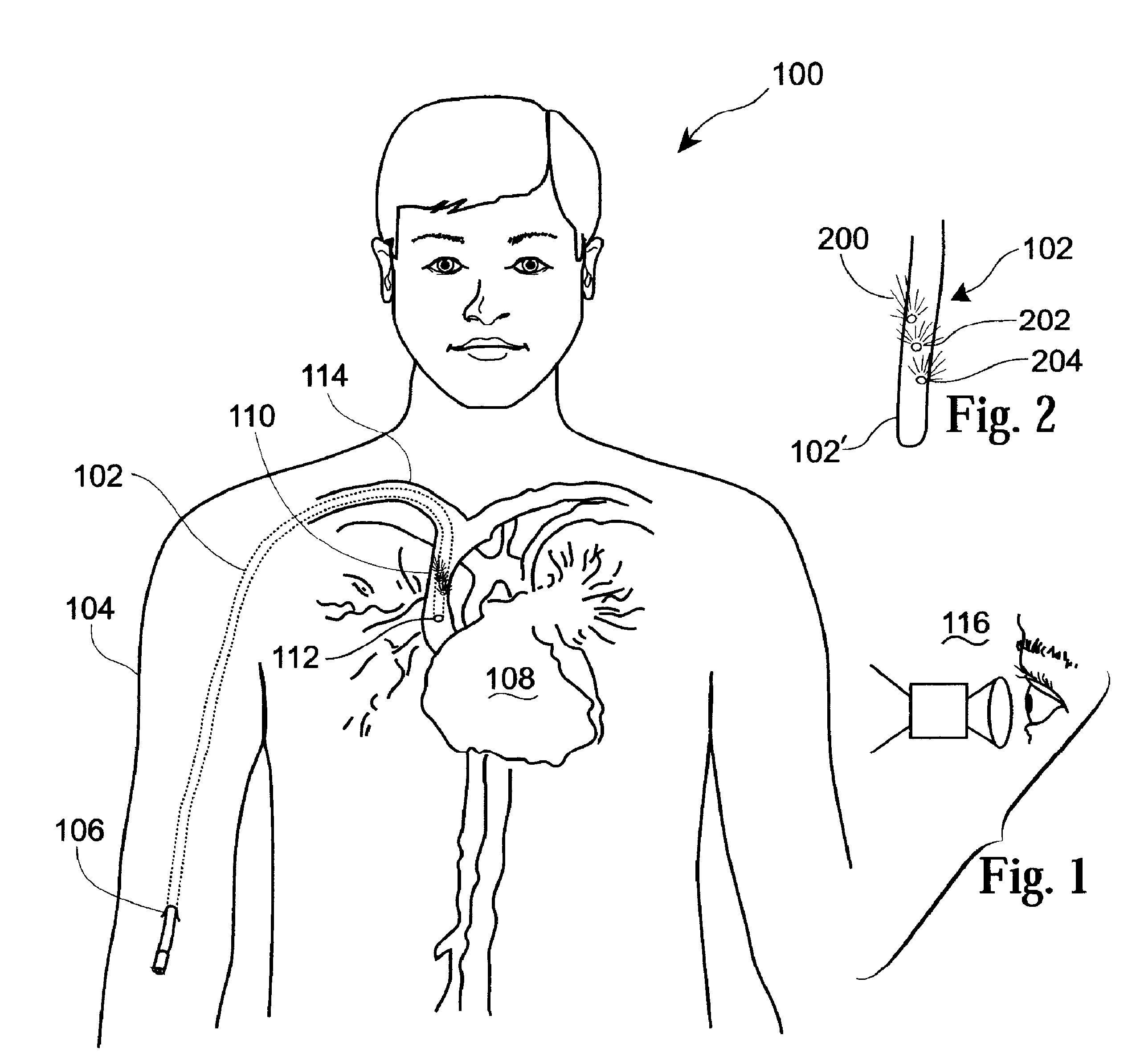 Determining inserted catheter end location and orientation