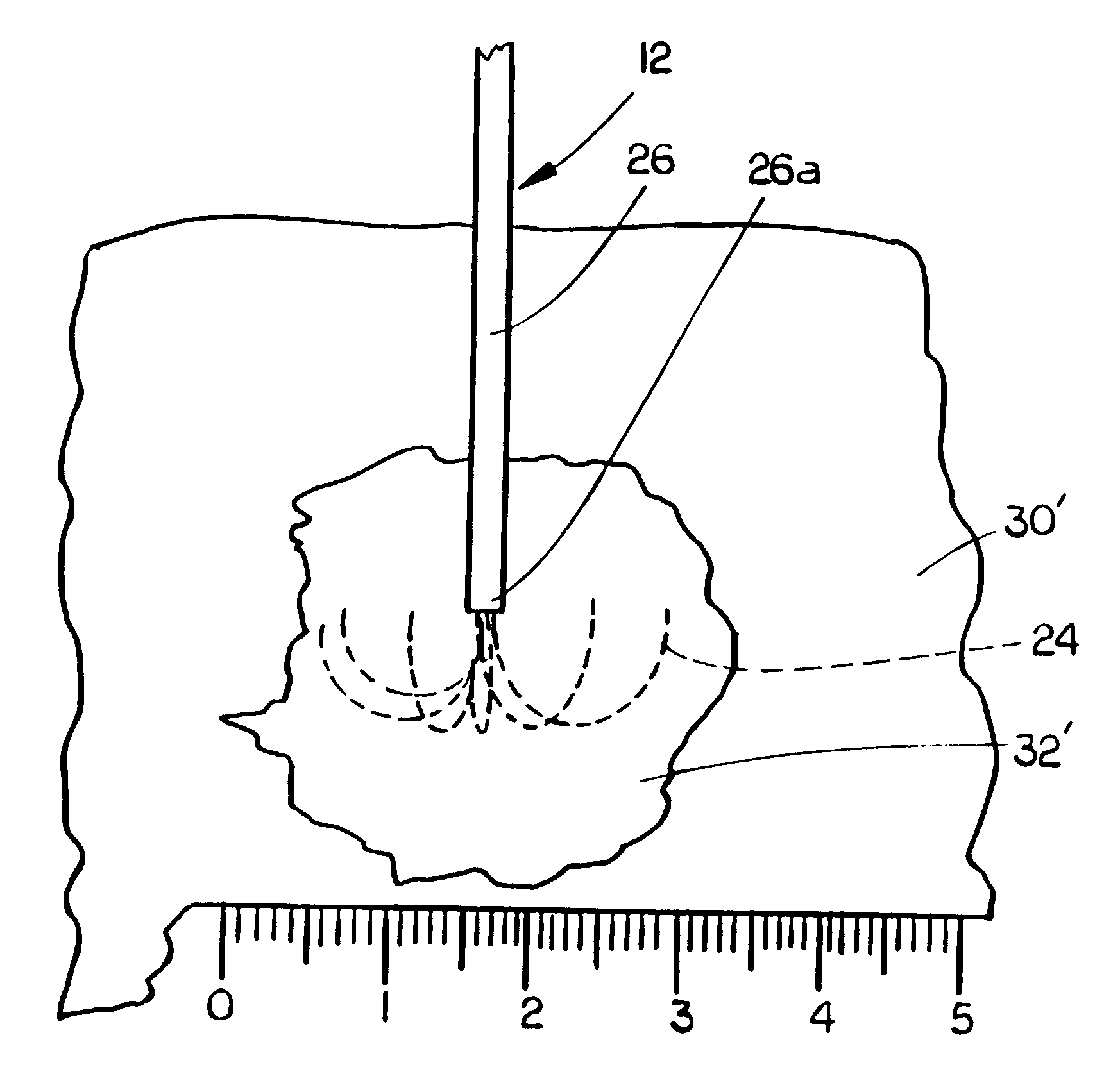 Methods for volumetric tissue ablation