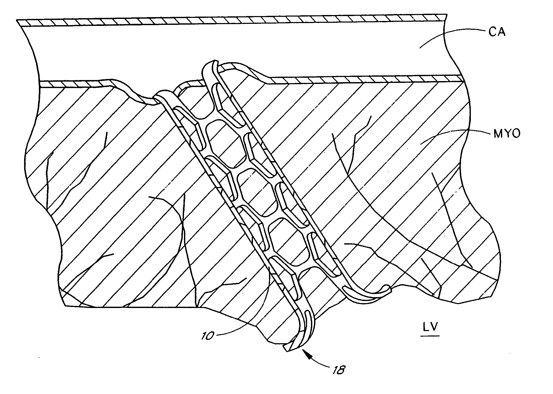 Designs for left ventricular conduit