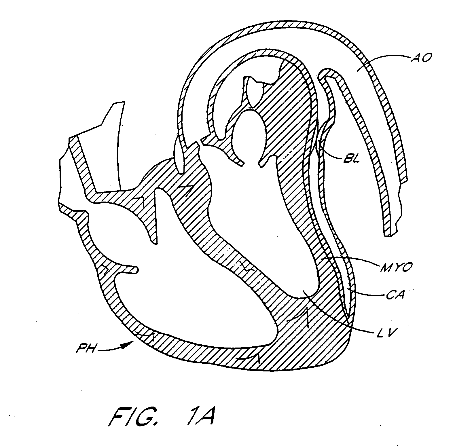 Designs for left ventricular conduit