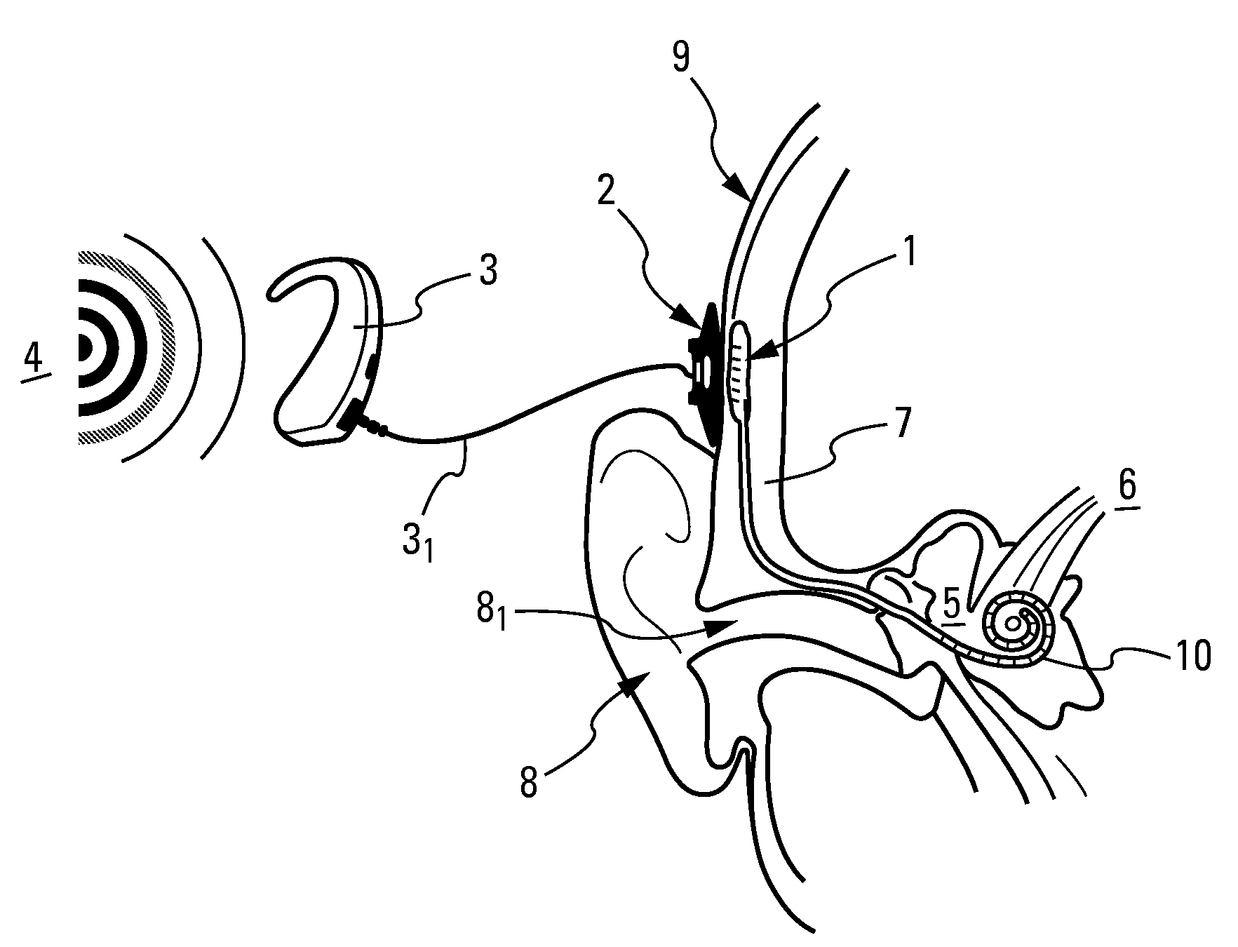 Implantable subcutaneous device