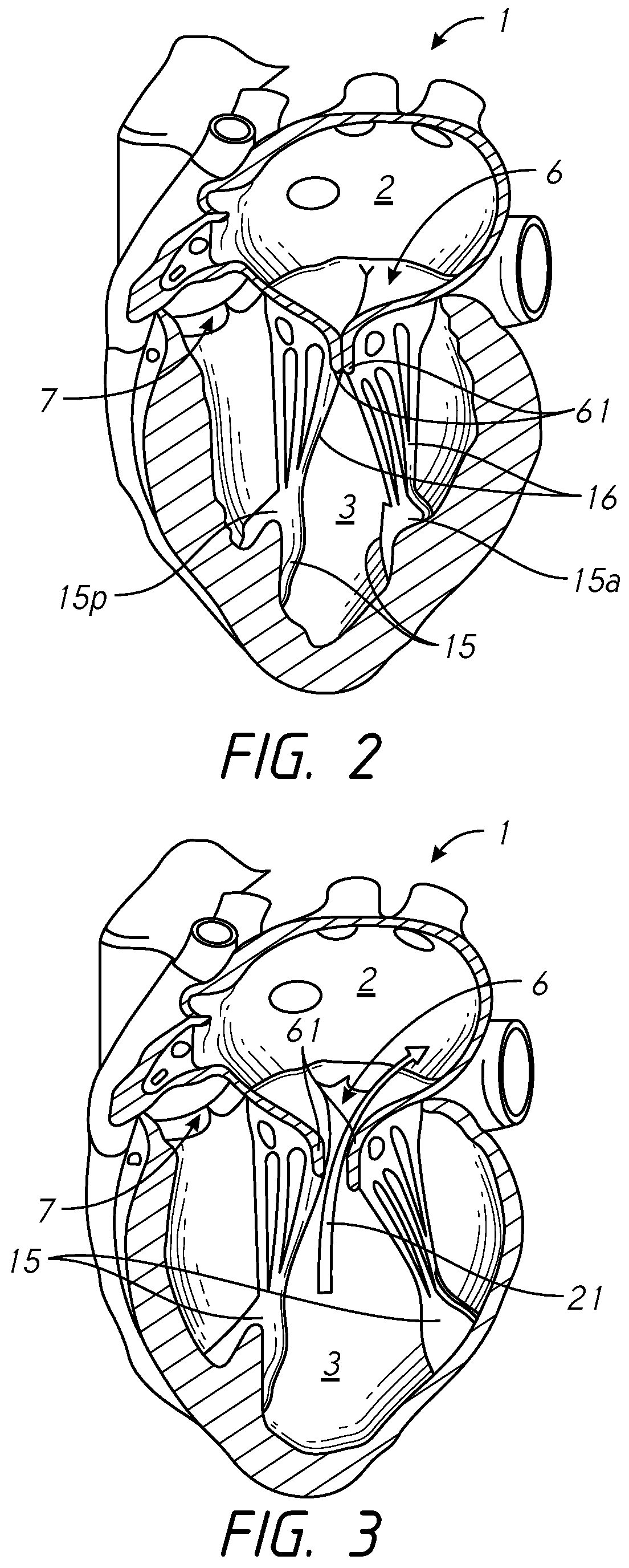 Spring and coil devices for papillary muscle approximation and ventricle remodeling