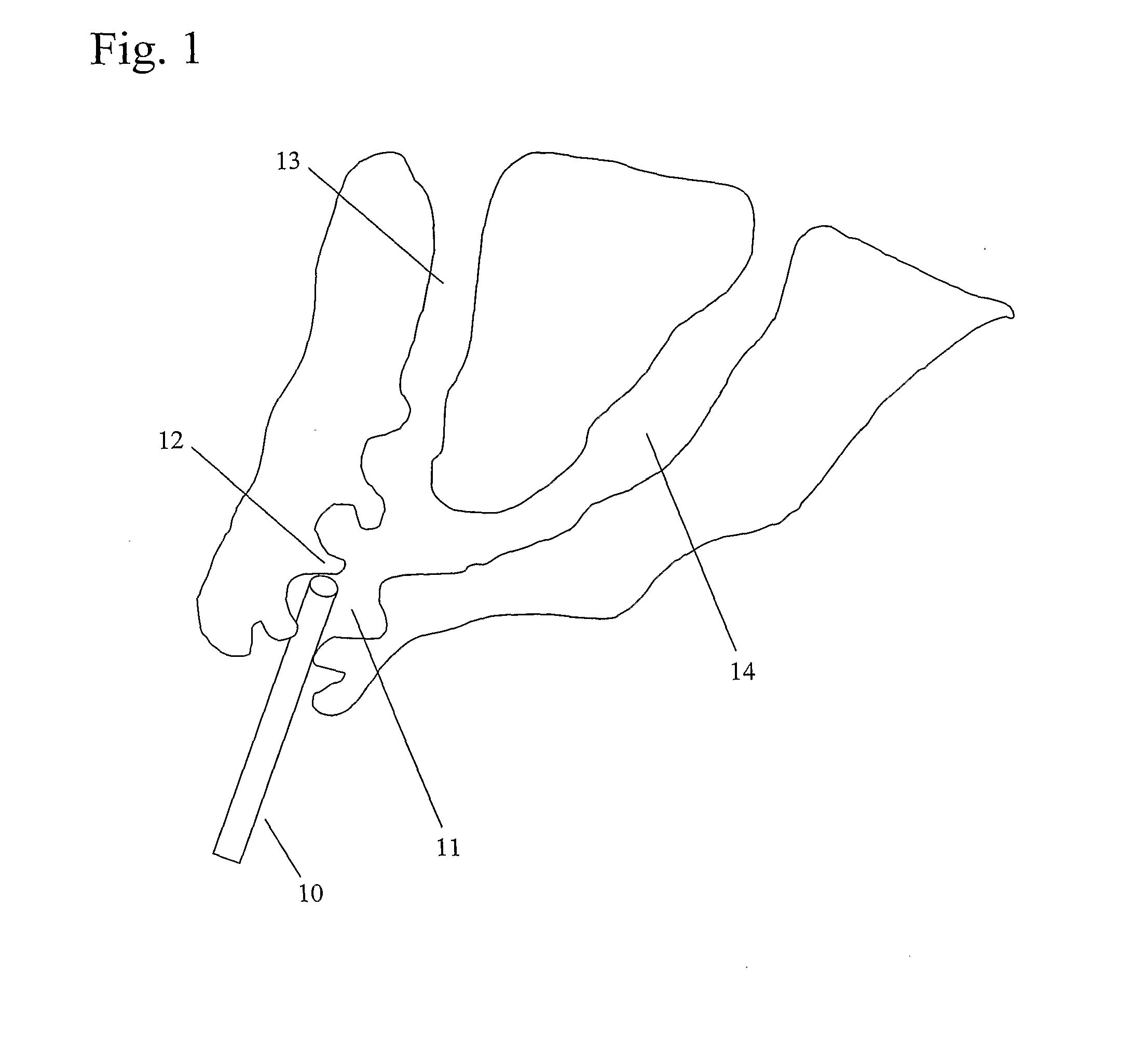 Method and Devices for Selective Endoscopic Retrograde Cholangiopancreatography