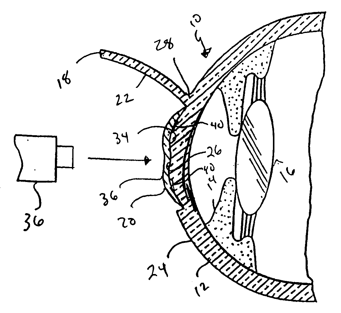 Device and method for reshaping the cornea