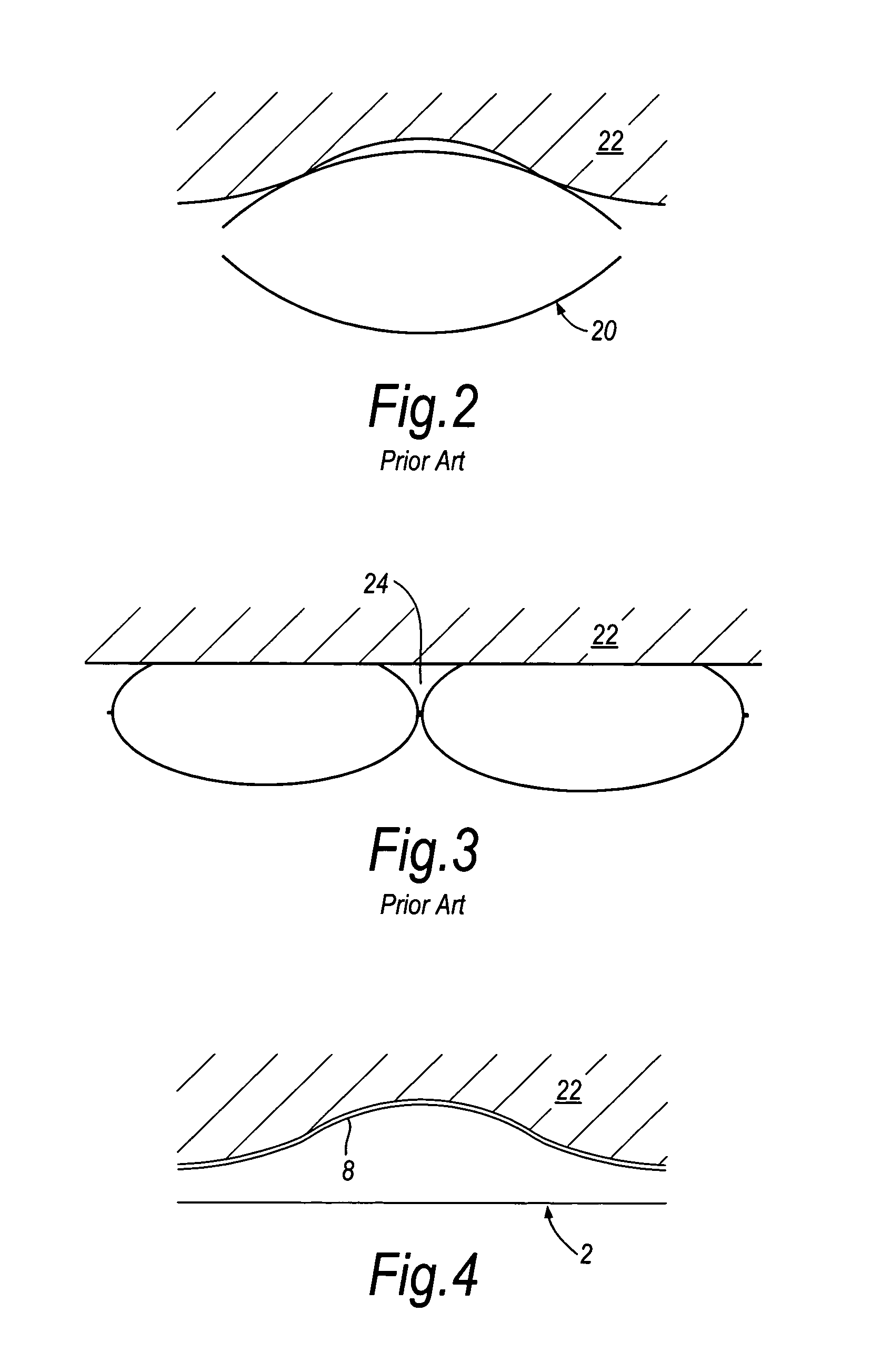 Compression device for the limb