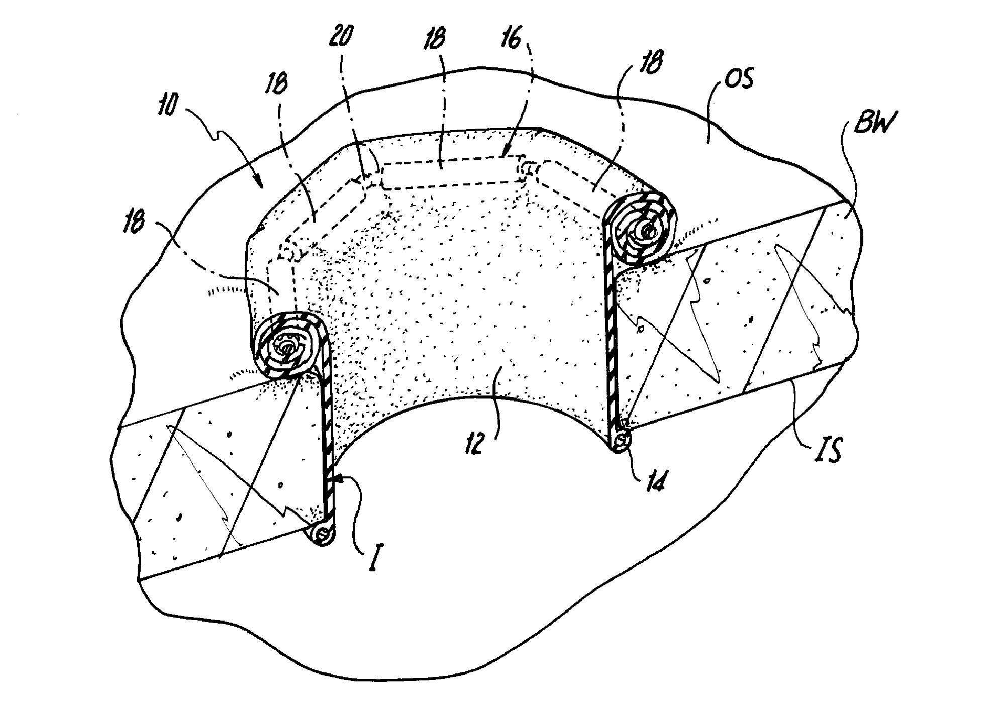 Surgical retractor including polygonal rolling structure