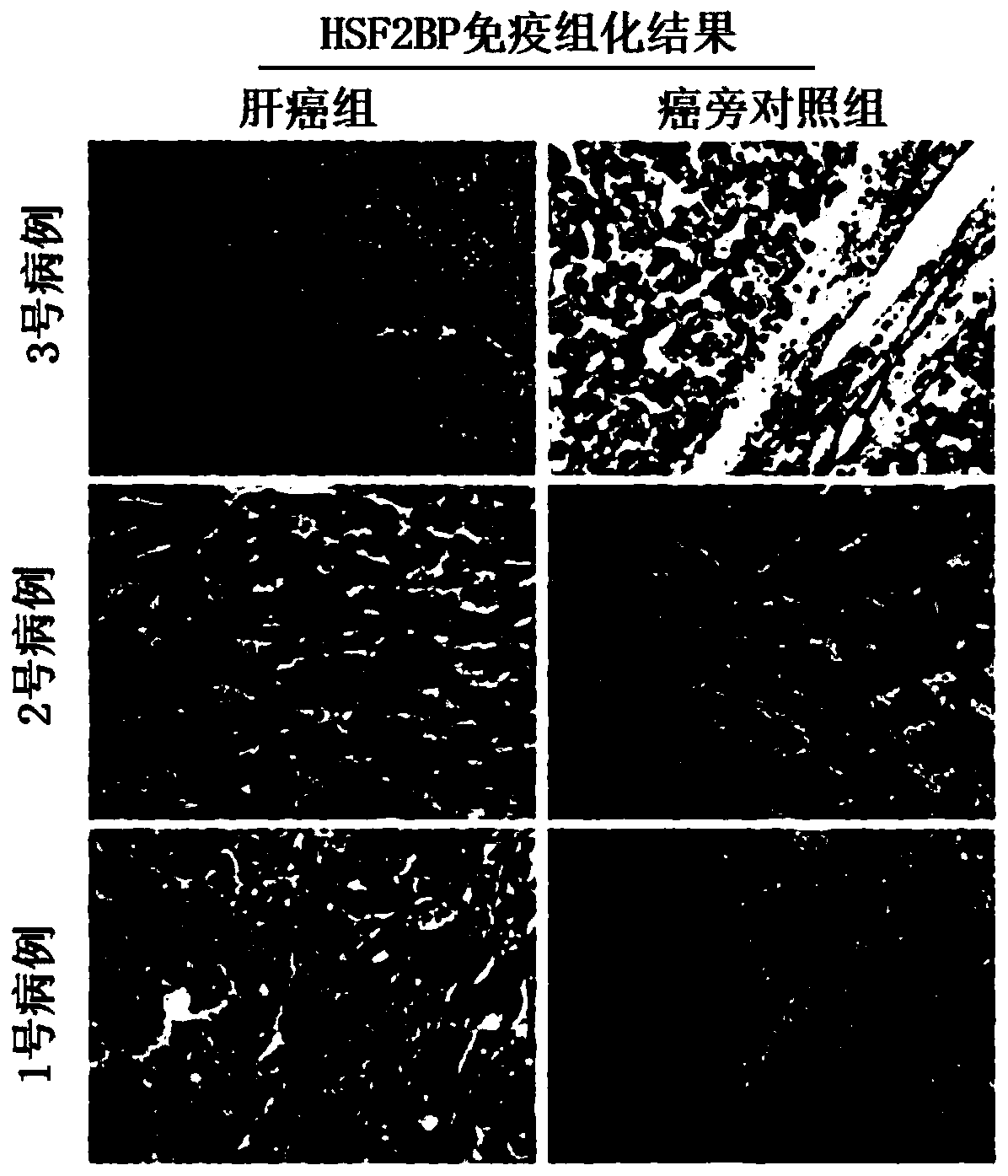 Liver cancer tumor marker heat shock factor 2 binding protein and application thereof