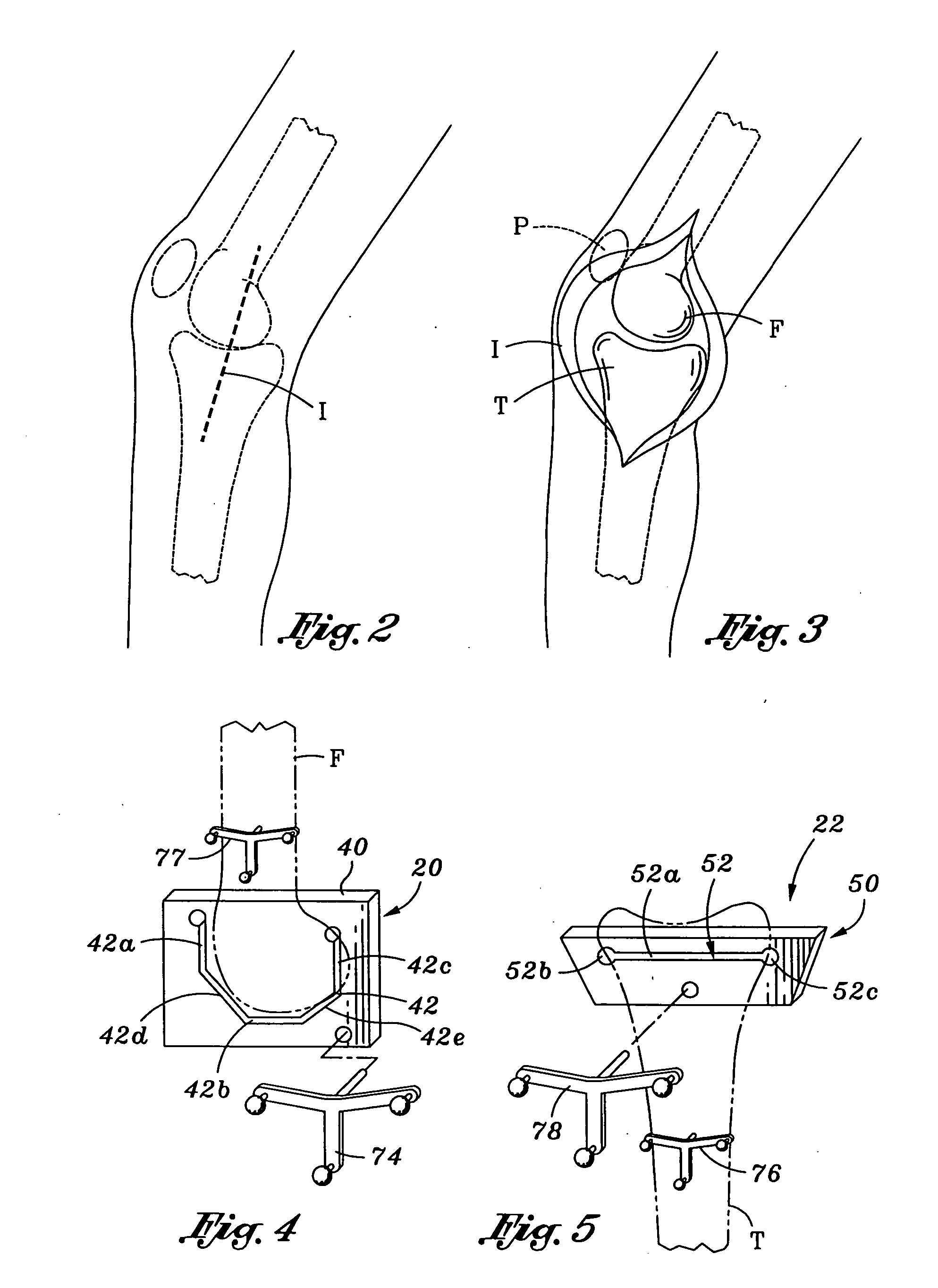 Patellar cutting guide